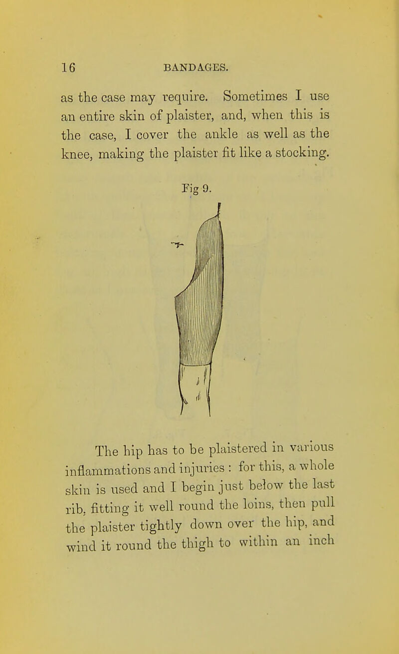 as the case may require. Sometimes I use an entire skin of plaister, and, when this is the case, I cover the ankle as well as the knee, making the plaister fit like a stocking. rig 9. The hip has to be plaistered in various inflammations and injuries : for this, a whole skin is used and I begin just below the last rib, fitting it well round the loins, then pull the plaister tightly down over the hip, and wind it round the thigh to within an inch