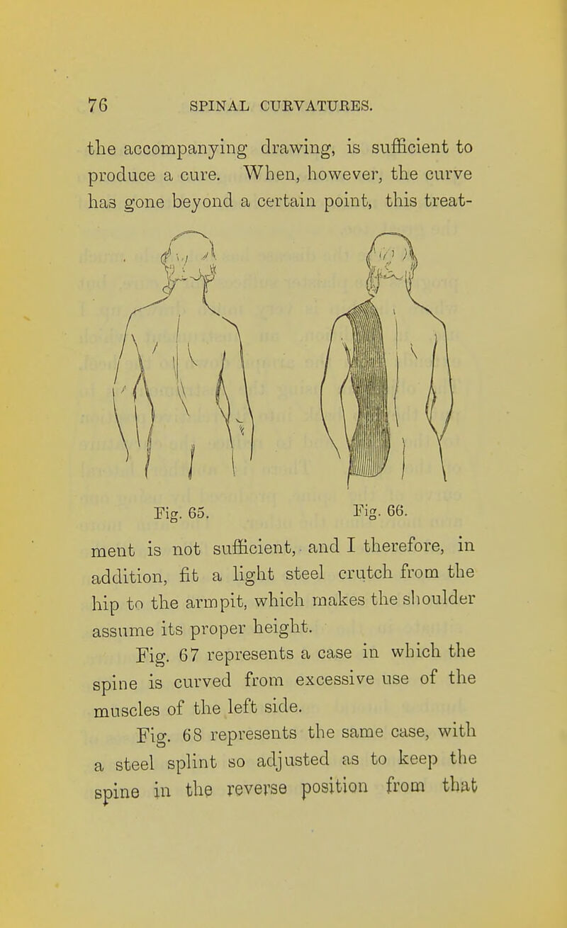 the accompanying drawing, is sufficient to produce a cure. When, however, the curve has gone beyond a certain point, this treat- Tig. 65. Eia. 66. ment is not sufficient, and I therefore, in addition, fit a light steel crutch from the hip to the armpit, which makes the shoulder assume its proper height. Fig. 67 represents a case in which the spine is curved from excessive use of the muscles of the left side. Fig. 68 represents the same case, with a steel splint so adjusted as to keep the spine in the reverse position from that