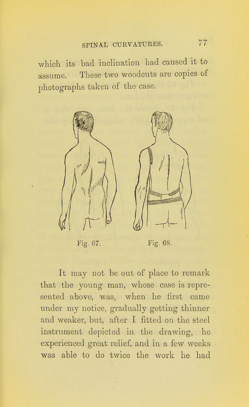 whicli its bad inclination bad caused it to assume. These two woodcuts are copies of photographs taken of the case. Fig. 67. Fig. 68. It may not be out of place to remark that the young man, whose case is repre- sented above, was, when he first came under my notice, gradually getting thinner and weaker, but, after I fitted on the steel instrument depicted in the drawing, he experienced great relief, and in a few weeks was able to do twice the work he had