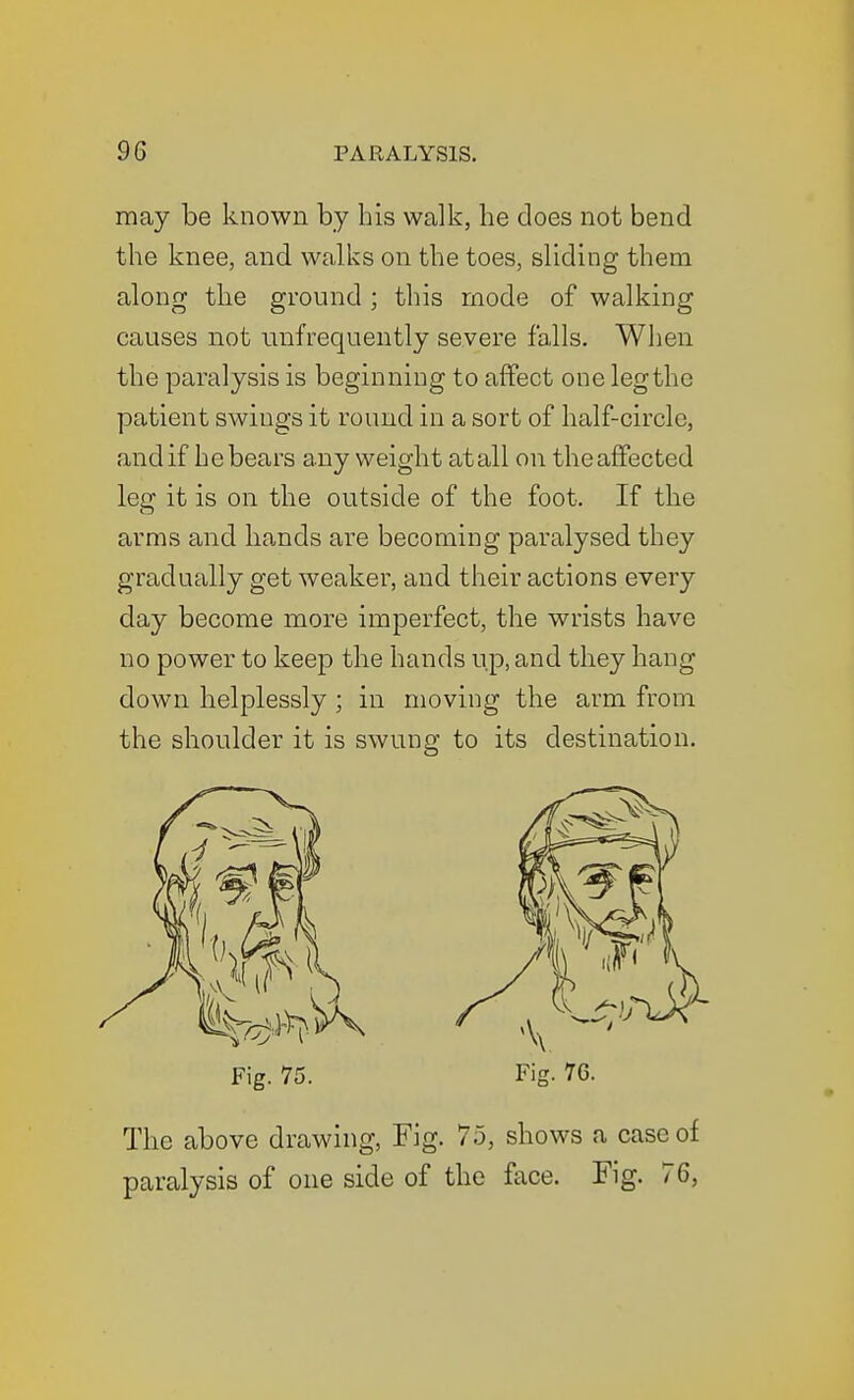 may be known by his walk, he does not bend the knee, and walks on the toes, sliding them along the ground ; this mode of walking causes not unfrequently severe falls. When the paralysis is beginning to affect one legthe patient swings it round in a sort of half-circle, and if he bears any weight at all on the affected leg it is on the outside of the foot. If the arms and hands are becoming paralysed they gradually get weaker, and their actions every day become more imperfect, the wrists have no power to keep the hands up, and they hang down helplessly ; in moving the arm from the shoulder it is swung to its destination. Fig. 75. Fig. 76. The above drawing, Fig. 75, shows a case of paralysis of one side of the face. Fig. 76,