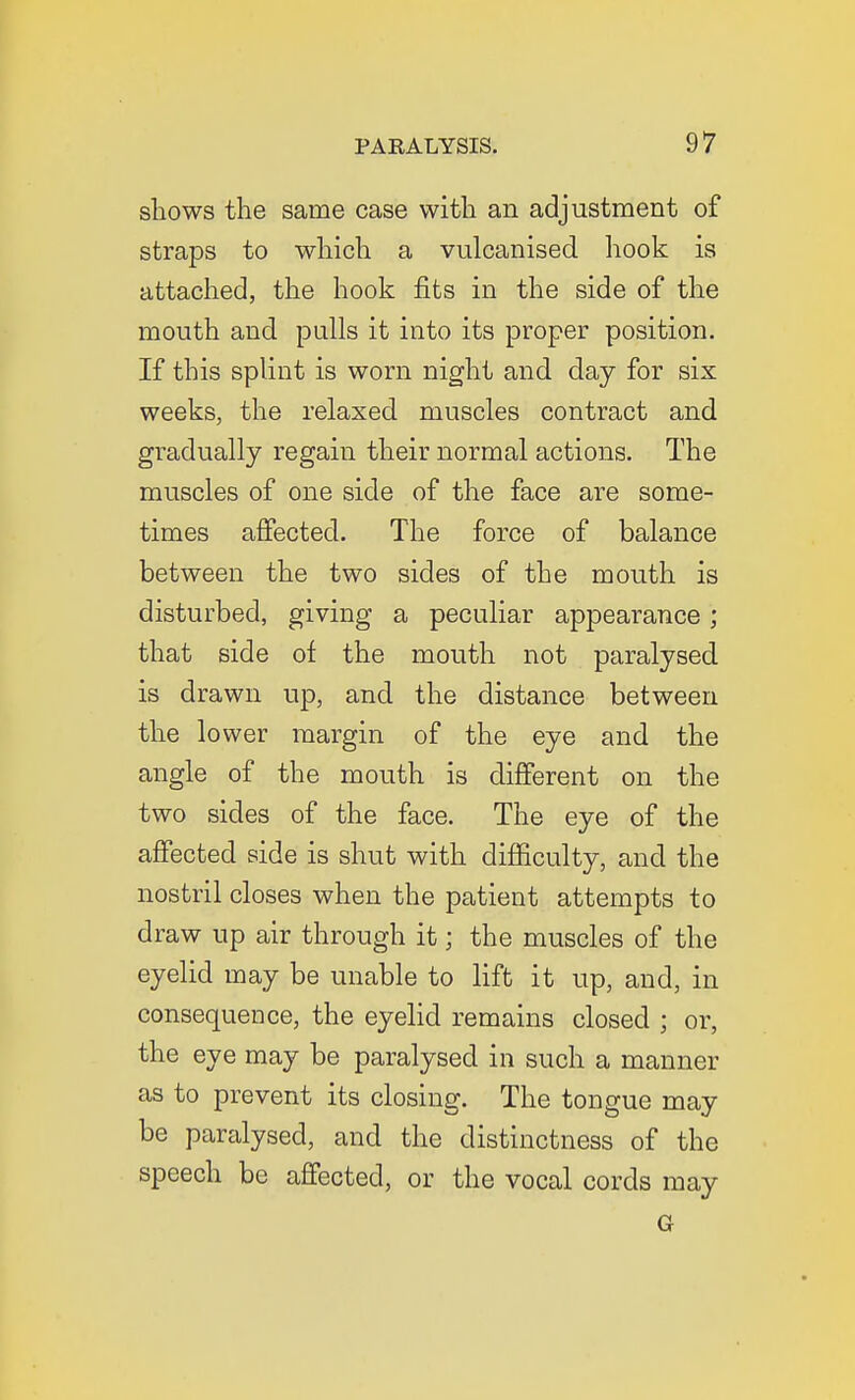 shows the same case with an adjustment of straps to which a vulcanised hook is attached, the hook fits in the side of the mouth and pulls it into its proper position. If this splint is worn night and day for six weeks, the relaxed muscles contract and gradually regain their normal actions. The muscles of one side of the face are some- times affected. The force of balance between the two sides of the mouth is disturbed, giving a peculiar appearance; that side of the mouth not paralysed is drawn up, and the distance between the lower margin of the eye and the angle of the mouth is difiPerent on the two sides of the face. The eye of the affected side is shut with difficulty, and the nostril closes when the patient attempts to draw up air through it; the muscles of the eyelid may be unable to lift it up, and, in consequence, the eyelid remains closed ; or, the eye may be paralysed in such a manner as to prevent its closing. The tongue may be paralysed, and the distinctness of the speech be affected, or the vocal cords may G