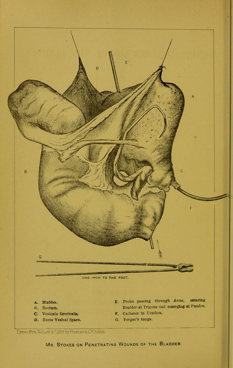 A. Bladder. It. Rcctnm. C. Ve»icnla SemlnsUs. O. Recto Vesical Space. E. Probe passing through Anus, entering Bladder (it Trigone anil emerglag «t Fnndns- F. Catheter In Urethra. G. Forger's tougs. Dt^v/n ff^ ra t.u re. &!Jith ? by Fors k e r & C Dulihn Mr. Stokes on Penetrating Wounds of the Bladder.