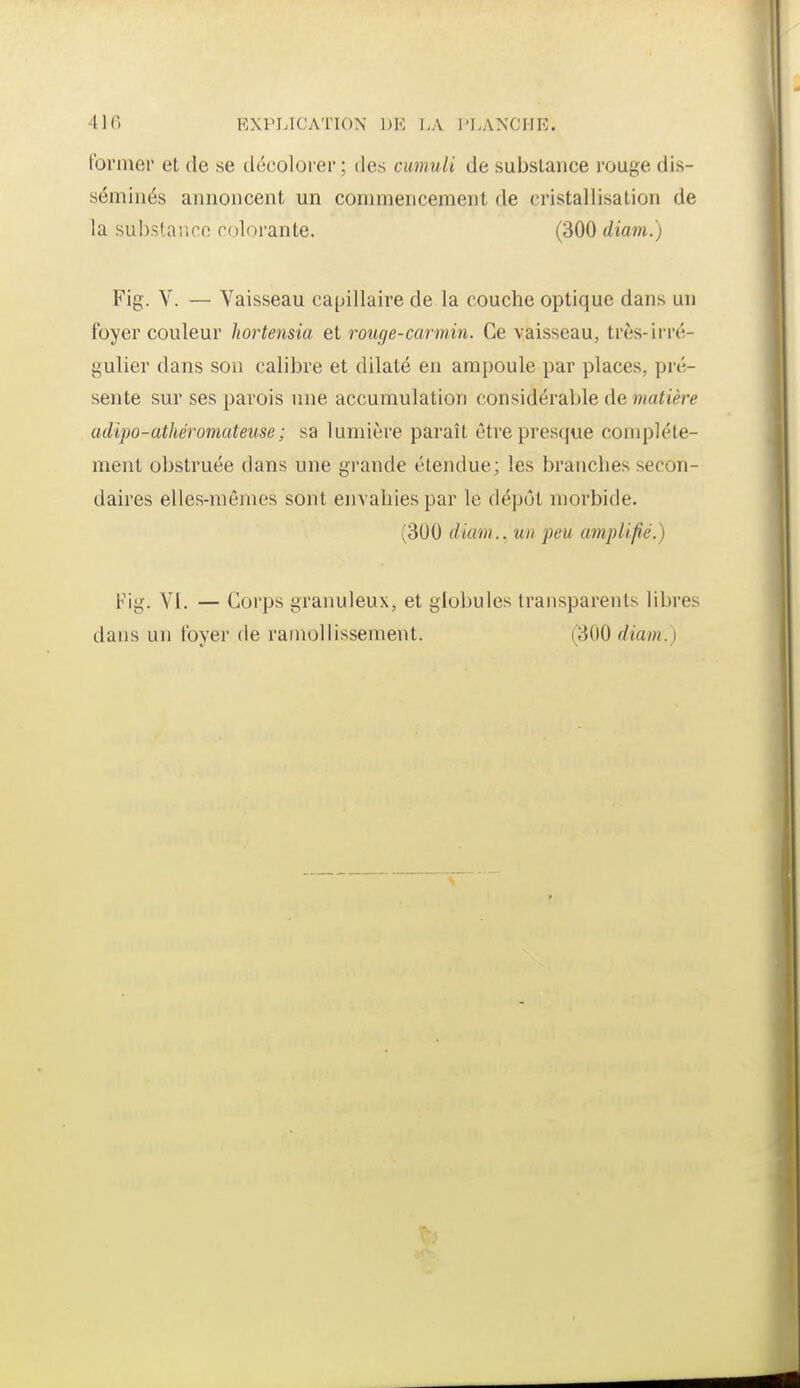 41fi RXPL1CATT0>,- DK I.A l'LANCIIE. tonner et de se décolorer; des cumuli de substance rouge dis- séminés annoncent un commencement de cristallisation de la substance colorante. (300 diam.) Fig. V. — Vaisseau capillaire de la couche optique dans un foyer couleur hortensia et rouge-carmin. Ce vaisseau, très-irré- gulier dans son calibre et dilaté en ampoule par places, pré- sente sur ses parois une accumulation considérable de matière adipo-athéromateuse; sa lumière paraît être presque complète- ment obstruée dans une grande étendue; les branches secon- daires elles-mêmes sont envahies par le dépôt morbide. (300 diam... un peu amplifié.) Fig. Yl. — Corps granuleux, et globules transparents libres dans un loyer de ramollissement. (300 diam.)