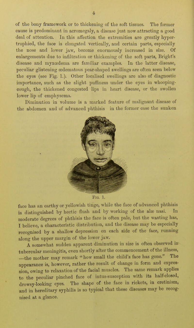 of the bouy framework or to thickening of the soft tissues. The former cause is predominant in acromegaly, a disease just now attracting a good deal of attention. In this affection the extremities are greatly hyper- trophied, the face is elongated vertically, and certain parts, especially the nose and lower jaw, become enormously increased in size. Of enlargements due to infiltration or thickening of the soft parts, Bright's disease and myxcedema are familiar examples. In the latter disease, peculiar glistening oedematous pear-shaped swelHngs are often seen below the eyes (see Fig. 1.). Other localised swellings are also of diagnostic importance, such as the slight puffiness under the eyes in whooping- cough, the thickened congested lips in heart disease, or the swollen lower lip of emphysema. Diminution in volume is a marked feature of malignant disease of the abdomen and of advanced phthisis in the former case the sunken Fig. 1. face has an earthy or yellowish tinge, while the face of advanced phthisis is distinguished by hectic flush and by working of the al» nasi. In moderate degrees of phthisis the face is often pale, but the wasting has, I believe, a characteristic distribution, and the disease may be especially recognised by a shallow depression on each side of the face, running along the upper margin of the lower jaw. A somewhat sudden apparent diminution in size is often observed in tubercular meningitis, even shortly after the commencement of the illness, the mother may remark how small the child's face has gone. The appearance is, however, rather the result of change in form and expres- sion, owing to relaxation of the facial muscles. The same remark applies to the peculiar pinched face of intus-susception with its half-closed, drowsy-looking eyes. The shape of the face in rickets, in cretinism, and in hereditary syphilis is so typical that these diseases may be recog- nised at a glance.