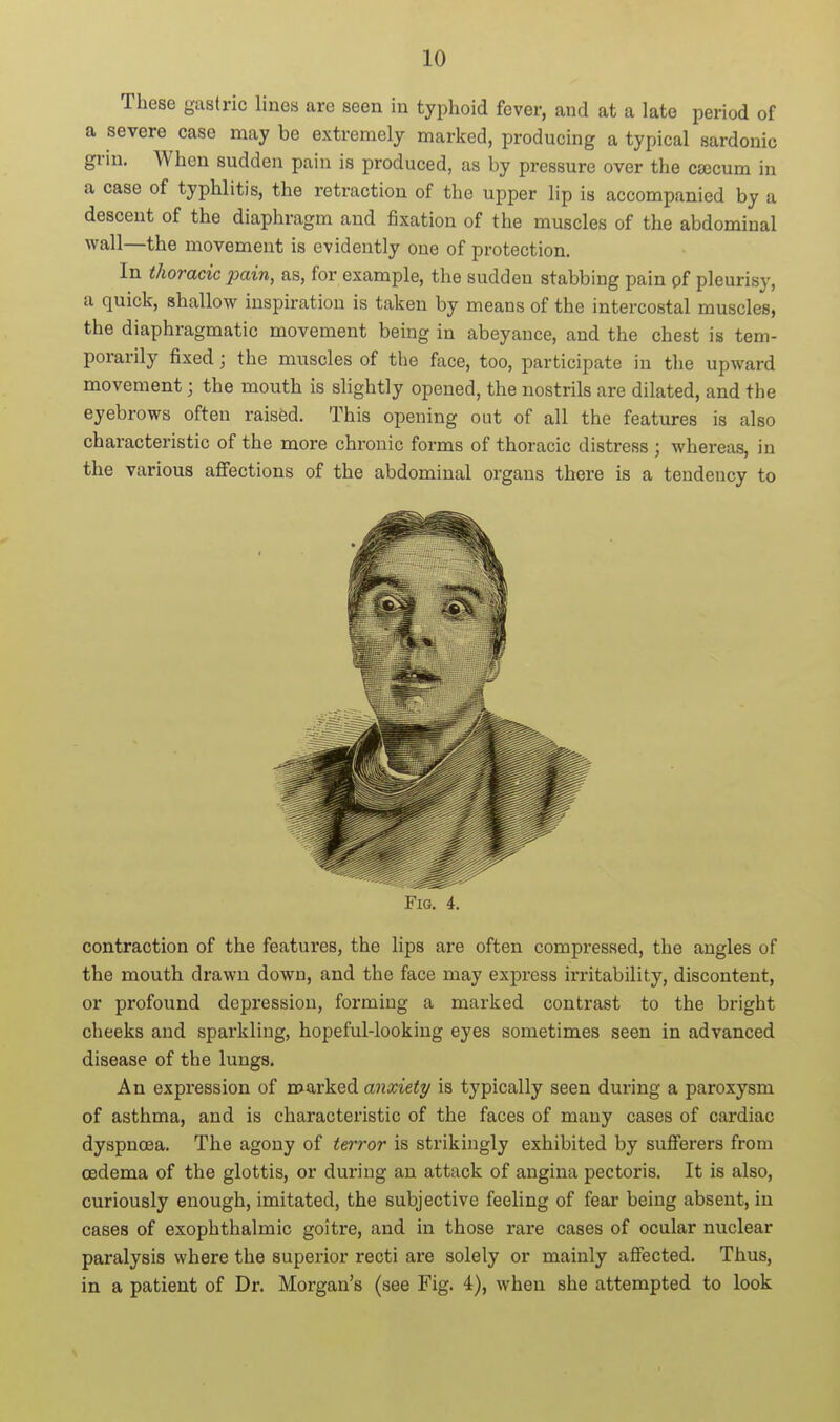 These gastric lines are seen in tyi^hoid fever, and at a late period of a severe case may be extremely marked, producing a typical sardonic gi-in. When sudden pain is produced, as by pressure over the csecum in a case of typhlitis, the retraction of the upper lip is accompanied by a descent of the diaphragm and fixation of the muscles of the abdominal wall—the movement is evidently one of protection. In thoracic pain, as, for example, the sudden stabbing pain pf pleurisy, a quick, shallow inspiration is taken by means of the intercostal muscles, the diaphragmatic movement being in abeyance, and the chest is tem- porarily fixed; the muscles of the face, too, participate in the upward movement; the mouth is slightly opened, the nostrils are dilated, and the eyebrows often raised. This opening out of all the features is also characteristic of the more chronic forms of thoracic distress ; whereas, in the various afiections of the abdominal organs there is a tendency to Fig. 4. contraction of the features, the lips are often compressed, the angles of the mouth drawn down, and the face may express irritability, discontent, or profound depression, forming a marked contrast to the bright cheeks and sparkling, hopeful-looking eyes sometimes seen in advanced disease of the lungs. An expression of roarked anxiety is typically seen during a paroxysm of asthma, and is characteristic of the faces of many cases of cardiac dyspnoea. The agony of terror is strikingly exhibited by sufferers from oedema of the glottis, or during an attack of angina pectoris. It is also, curiously enough, imitated, the subjective feeling of fear being absent, in cases of exophthalmic goitre, and in those rare cases of ocular nuclear paralysis where the superior recti are solely or mainly affected. Thus, in a patient of Dr. Morgan's (see Fig. 4), when she attempted to look