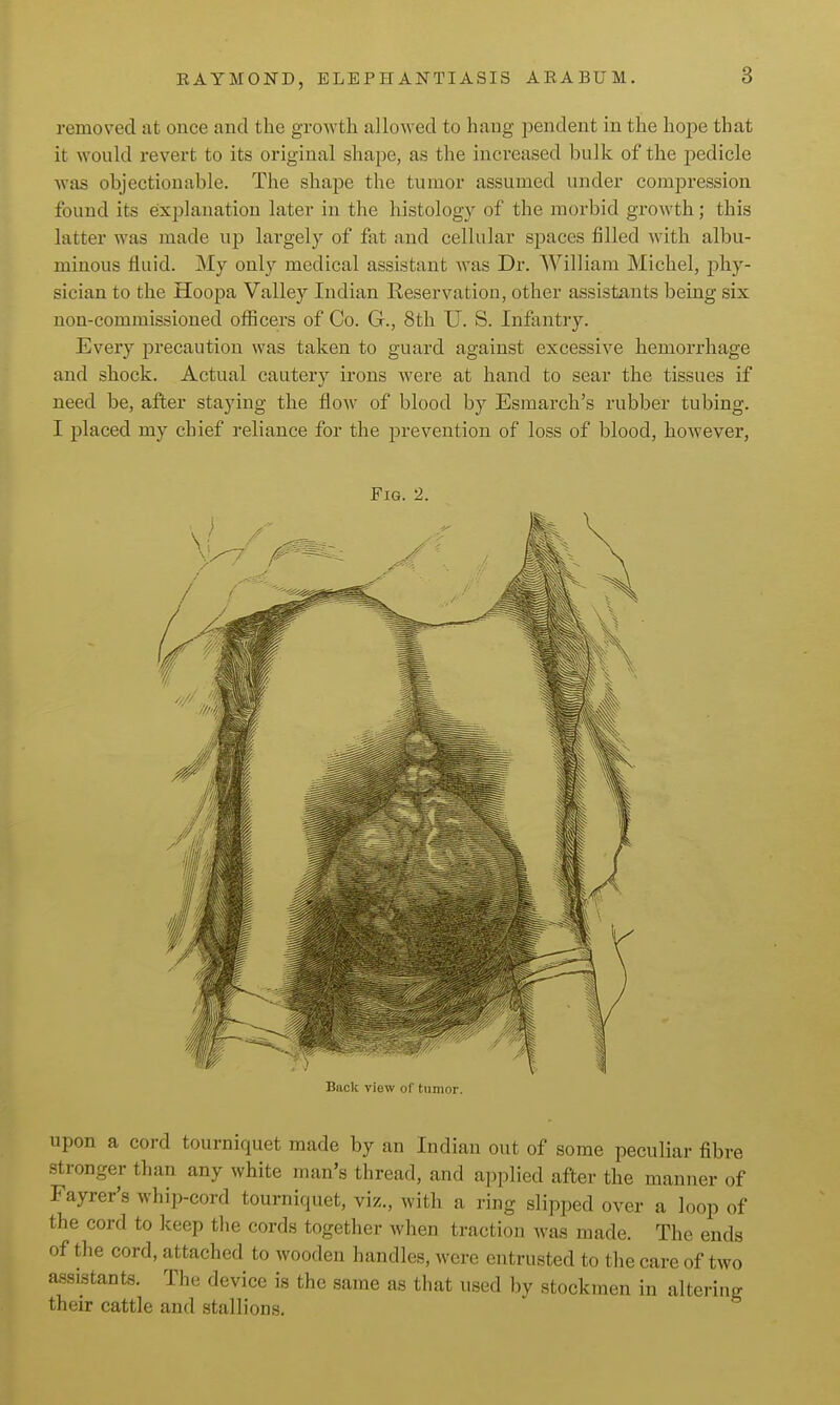 removed at once and the growtli allowed to hang pendent in the hope that it would revert to its original shape, as the increased bulk of the pedicle was objectionable. The shape the tumor assumed under compression found its explanation later in the histology of the morbid growth; this latter was made up largely of fat and cellular spaces filled with albu- minous fluid. My only medical assistant was Dr. William Michel, phy- sician to the Hoopa Valley Indian Reservation, other assistants being six non-commissioned officers of Co. G., 8th U. S. Infantry. Every precaution was taken to guard against excessive hemorrhage and shock. Actual cautery irons were at hand to sear the tissues if need be, after staying the flow of blood by Esmarch's rubber tubing. I placed my chief reliance for the prevention of loss of blood, however, Fig. 2. Back view of tumor. upon a cord tourniquet made by an Indian out of some peculiar fibre stronger than any white man's thread, and apjilied after the manner of Fayrer's whip-cord tourniquet, viz., with a ring slipped over a loop of the cord to keep the cords together when traction was made. The ends of the cord, attached to wooden handles, were entrusted to the care of two assistants. The device is the same as that used by stockmen in altering their cattle and stallions.