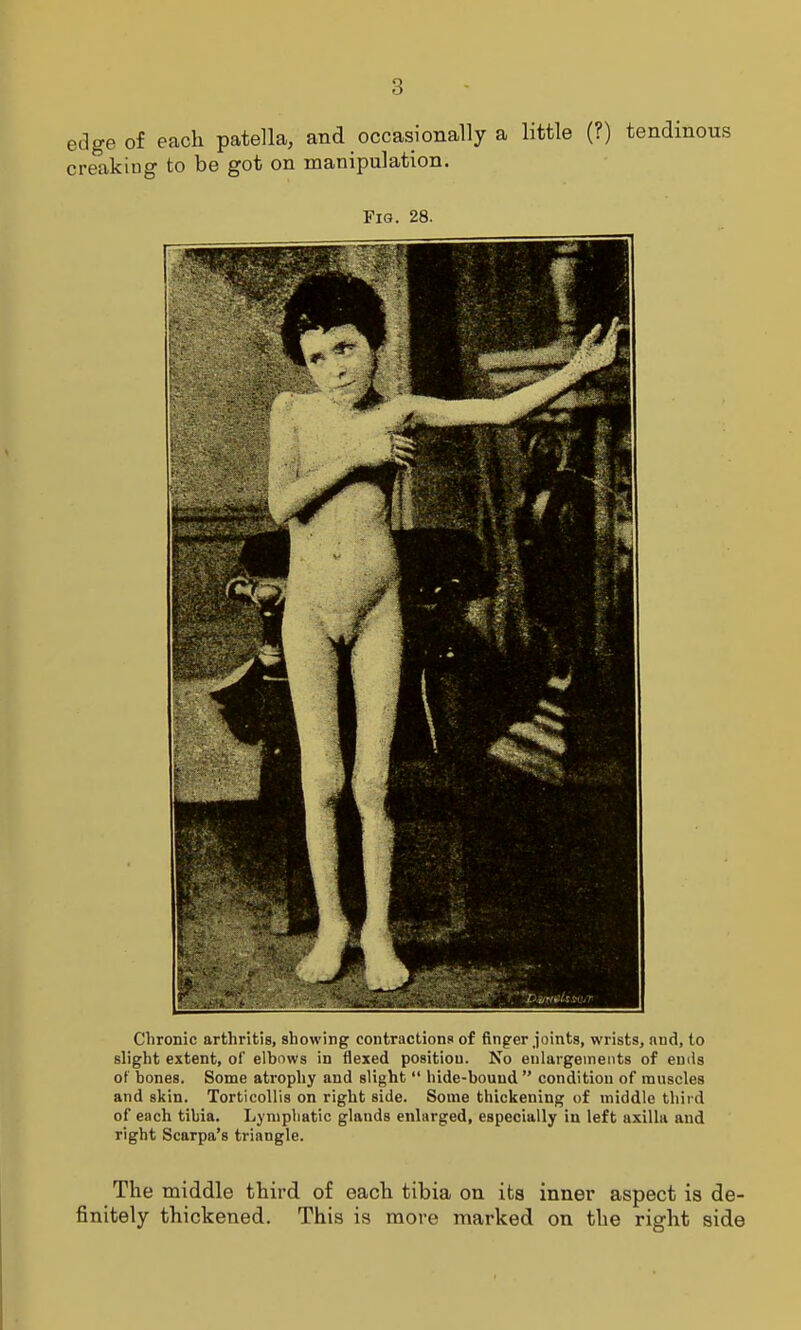 edge of each patella, and occasionally a little (?) tendinous creaking to be got on manipulation. Fig. 28. Chronic arthritis, showing contractions of finger Joints, wrists, and, to slight extent, of elbows in flexed position. No enlargements of ends of hones. Some atrophy and slight  hide-bound  condition of muscles and skin. Torticollis on right side. Some thickening of middle third of each tihia. Lynipliatlc glands enlarged, especially in left axilla and right Scarpa's triangle. The middle third of each tibia on its inner aspect is de- finitely thickened. This is more marked on the right side