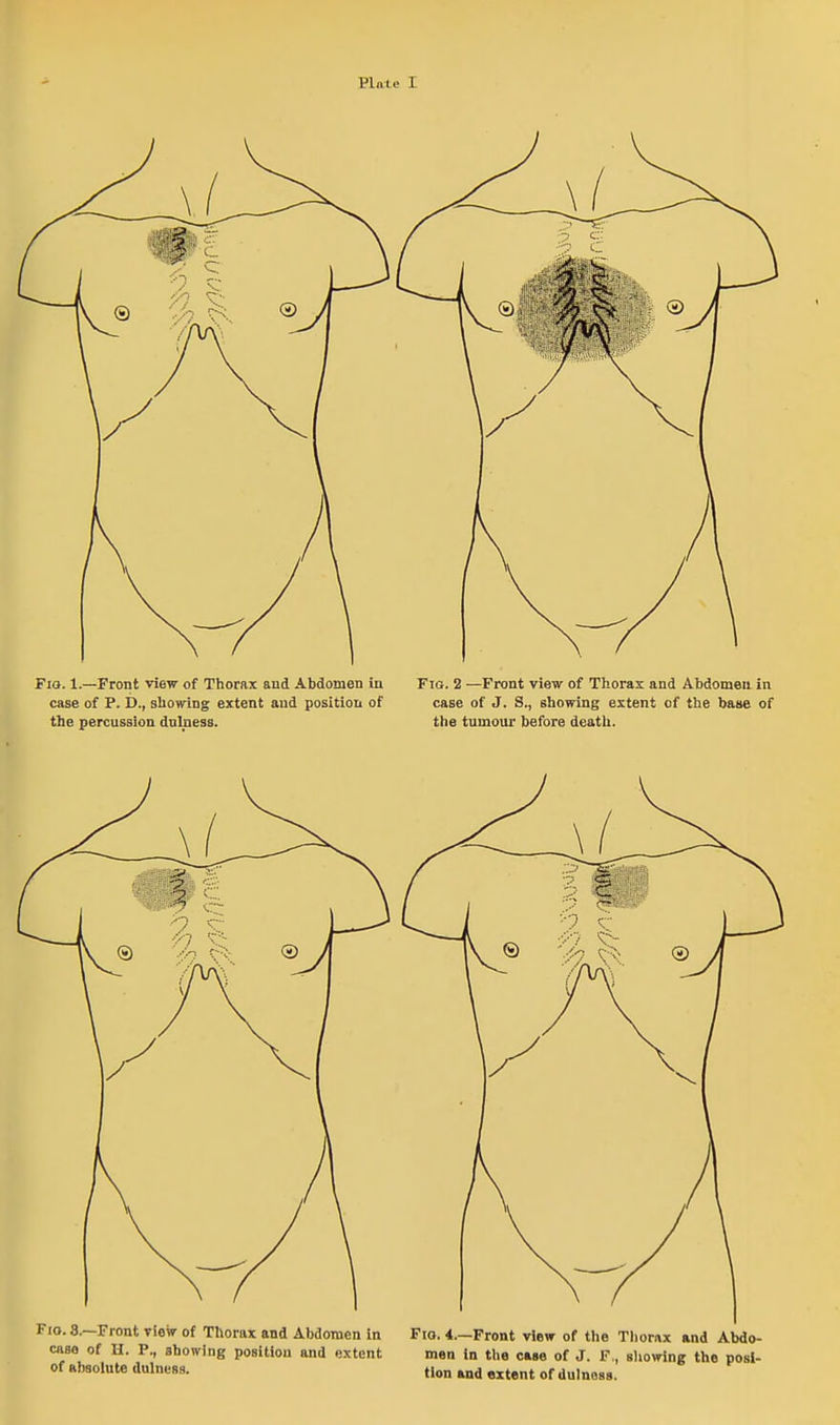 Hnle I Fio. 8.—Front view of Thorax and Abdornen in caaa of H. P., showing position and extent of absolute dulnesa. Fio. 4.—Front view of the Tliori\x and Abdo- men in tlie case of J. F,, siiowing the posi- tion and extent of dulnoss.