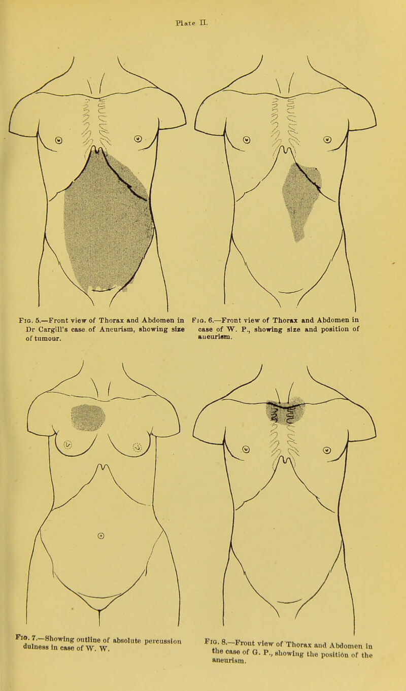 FiG. 6.—Front view of Thorax and Abdomen in Fio. 6.—Front view of Thorax and Abdomen in Dr CargiU's case of Anenrism, showing size case of W. P., showing size and position of of tumour. aneurism.