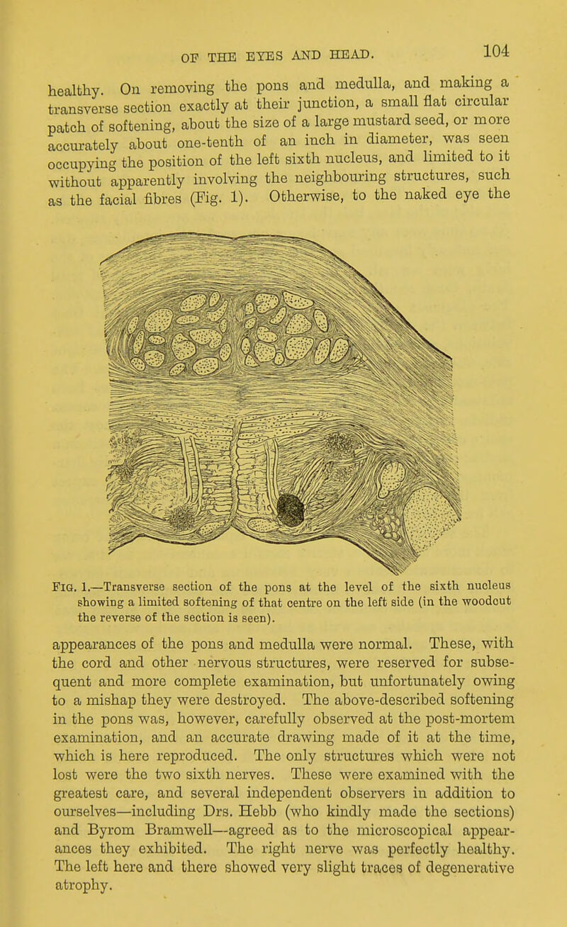 healthy. On removing the pons and medulla, and making a transverse section exactly at their junction, a small flat circular patch of softening, about the size of a large mustard seed, or more accurately about one-tenth of an inch in diameter, was seen occupying the position of the left sixth nucleus, and limited to it without apparently involving the neighbouring structures, such as the facial fibres (Fig. 1). Otherwise, to the naked eye the Fia. 1.—Transverse section of the pons at the level of the sixth nucleus showing a limited softening of that centre on the left side (in the woodcut the reverse of the section is seen). appearances of the pons and medulla were normal. These, with the cord and other nervous structures, were reserved for subse- quent and more complete examination, but unfortunately ovdng to a mishap they were destroyed. The above-described softening in the pons was, however, carefully observed at the post-mortem examination, and an accurate drawing made of it at the time, which is here reproduced. The only structures which were not lost were the two sixth nerves. These were examined with the greatest care, and several independent observers in addition to ourselves—including Drs. Hebb (who kindly made the sections) and Byrom Bramwell—agreed as to the microscopical appear- ances they exhibited. The right nerve was perfectly healthy. The left here and there showed very slight traces of degenerative atrophy.