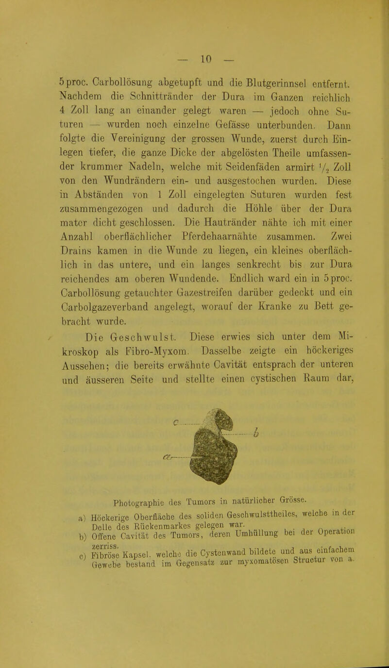 5proc. Carbollosung abgetupft und die Blutgerinnsel entfernt. Nachdem die Sehnittninder der Dura ira Ganzen reichlich 4 ZoU lang an einander gelegt waren — jedoch ohnc Su- tiiren — warden noch einzelne Gefasse unterbunden. Dann folgte die Vereinigang der grossen Wunde, zuerst durch Ein- legen tiefer, die ganze Dicke der abgelosten Theile umfassen- der krummer Nadeln, welche mit Seidenfaden arrairt '/., ZoU von den Wundrandern ein- und ausgestochen wurden. Diese in Abstanden von 1 Zoli eingelegten Suturen wurden fest zusamraengezogen mid dadurch die Hohle iiber der Dura mater dicht geschlossen. Die Hautrauder nahtc ich mit einer Anzabl oberflachlicher Pfcrdehaarnahte zusammen. Zwoi Drains karaen in die Wunde zu liegen, ein kleines oberflach- lich in das untere, und ein langes senkreclit bis zur Dura reichendes am oberen Wundende. Endlich ward ein in 5proc. CarbollSsung getauchter Gazestreifen dariiber gedeokt und ein Carbolgazevcrband angelegt, worauf der Kranke zu Bett ge- bracht wurde. Die Geschwulst. Diese erwies sich unter dera Mi- kroskop als Fibro-Myxom. Dasselbe zeigte ein hockeriges Aussehen; die bereits erwahnte Cavitat entsprach der unteren und ausseren Seitc und stellte einen cystischen Raum dar, Photographic des Tumors in natiirlicher Grosse. a) Hockerige Oberflache des soliden Geschwulsttheiles, welche in der Delle des Ruckenmarkes gelegen war. b) Offene Cavitat des Tumors, deren Umhullung bei der Operation c) MbrSe Kapsel. welchc die Cysteawand bildelc ^^^^^'.'^f^^f'''; Gewebe bestand im Gegensatz zur myxomatosen Structur von a.