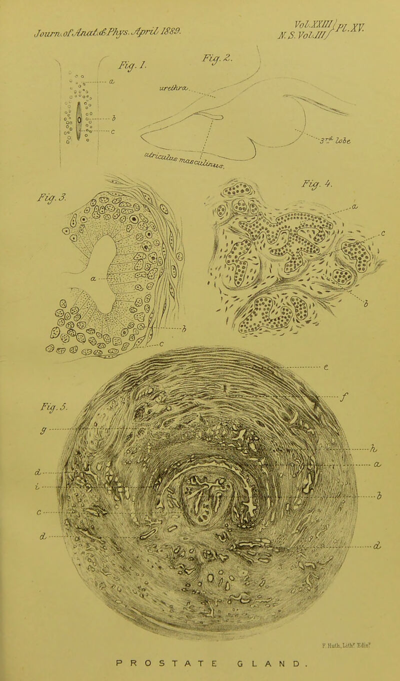 F Huth.LithrEainT PROSTATE GLAND