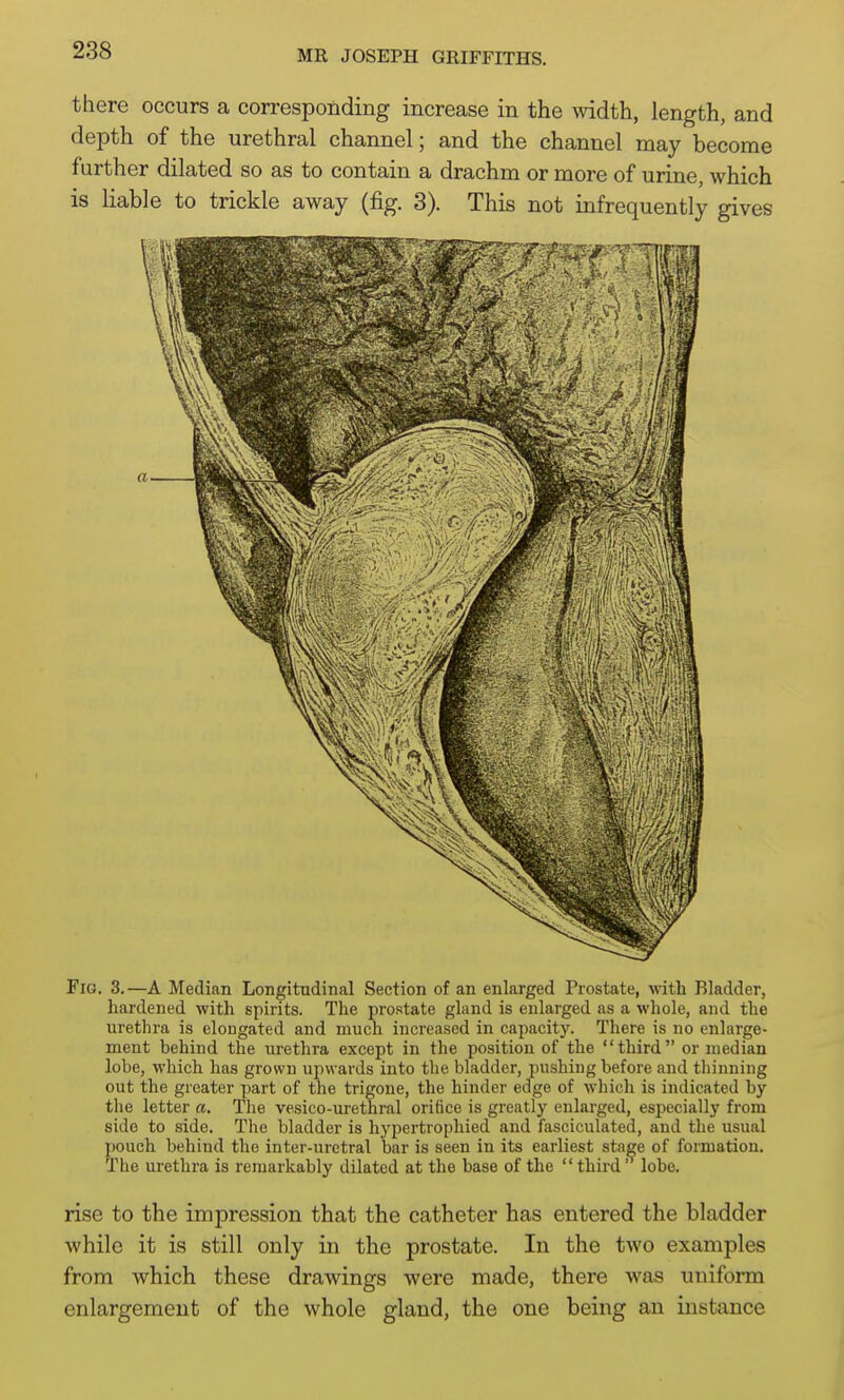 there occurs a corresponding increase in the width, length, and depth of the urethral channel; and the channel may become further dilated so as to contain a drachm or more of urine, which is liable to trickle away (fig. 3). This not infrequently gives Fig. 3.—A Median Longitudinal Section of an enlarged Prostate, with Bladder, hardened with spirits. The prostate gland is enlarged as a whole, and the urethra is elongated and much increased in capacity. There is no enlarge- ment behind the urethra except in the position of the third or median lobe, which has grown upwards into the bladder, pushing before and thinning out the greater part of the trigone, the hinder edge of which is indicated by the letter a. The vesico-urethral orifice is greatly enkrged, especially from side to side. The bladder is hj'pertropliied and fasciculated, and the usual pouch behind the inter-uretral bar is seen in its earliest stage of formation. The urethra is remarkably dilated at the base of the  third' lobe, rise to the impression that the catheter has entered the bladder while it is still only in the prostate. In the two examples from which these drawings were made, there was uniform enlargement of the whole gland, the one being an instance