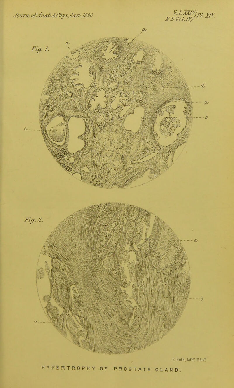 . ofJ7iai.d,Phys.,JaJV.1890. -rf$i>?^ 3 a- F. H^ith, LiUiT EdinT HYPERTROPHY OF PROSTATE GLAND.