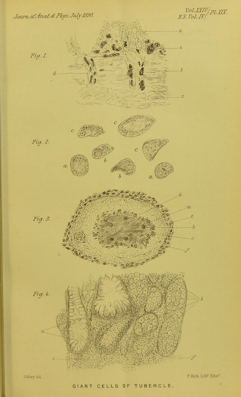 JoiirTb.ofJnat.dPh^s.JuIylS90. KS. Vol.W ■ a- tf. e ...3 Siljley del. GIANT CELLS OF TUBERCLE Y HuOi,],ilir Edin'