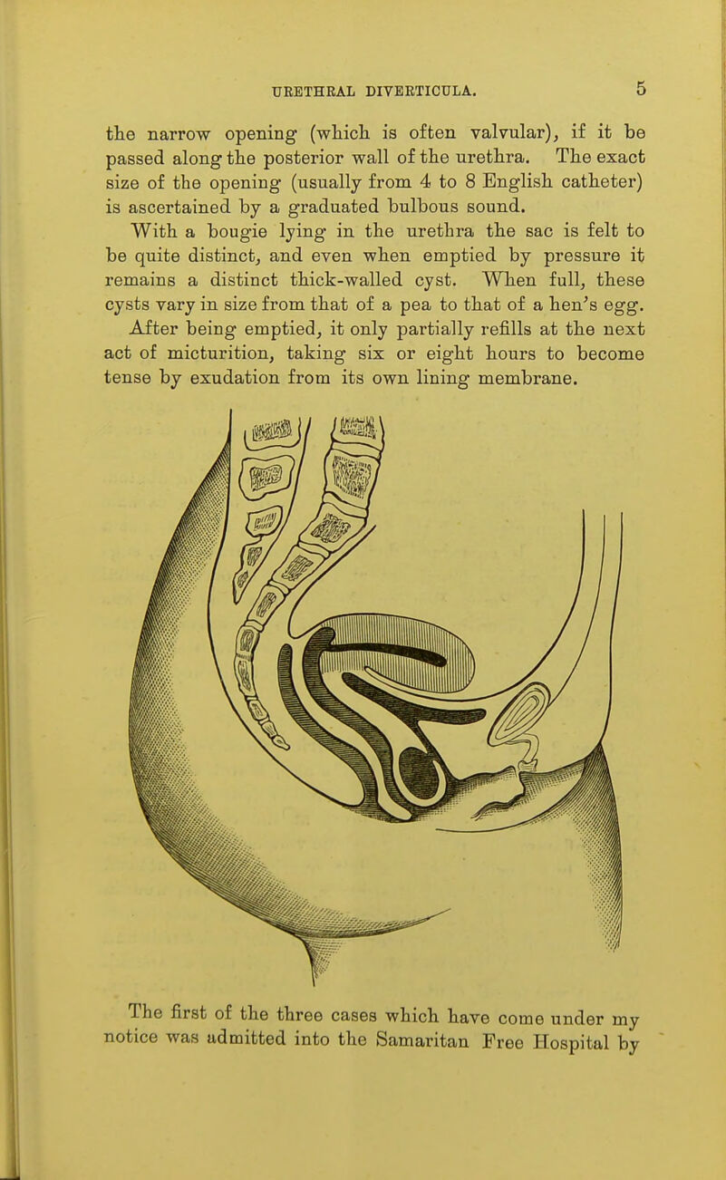 the narrow opening (wliicli is often valvular), if it be passed along tlie posterior wall of the urethra. The exact size of the opening (usually from 4 to 8 English catheter) is ascertained by a graduated bulbous sound. With a bougie lying in the urethra the sac is felt to be quite distinct, and even when emptied by pressure it remains a distinct thick-walled cyst. When full, these cysts vary in size from that of a pea to that of a hen^s egg. After being emptied, it only partially refills at the next act of micturition, taking six or eight hours to become tense by exudation from its own lining membrane. The first of the three cases which have come under my notice was admitted into the Samaritan Free Hospital by