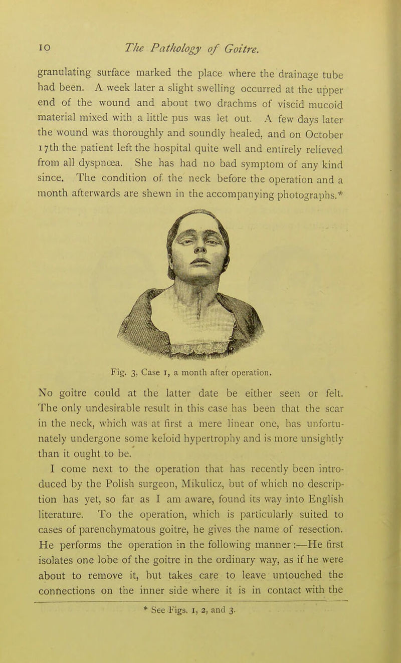 granulating surface marked the place where the drainage tube had been. A week later a slight swelling occurred at the upper end of the wound and about two drachms of viscid mucoid material mixed with a little pus was let out. A few days later the wound was thoroughly and soundly healed, and on October 17th the patient left the hospital quite well and entirely relieved from all dyspnoea. She has had no bad symptom of any kind since. The condition of the neck before the operation and a month afterwards are shewn in the accompanying photographs.* Fig. 3, Case r, a month after operation No goitre could at the latter date be either seen or felt. The only undesirable result in this case has been that the scar in the neck, which was at first a mere linear one, has unfortu- nately undergone some keloid hypertrophy and is more unsightly than it ought to be. I come next to the operation that has recently been intro- duced by the Polish surgeon, Mikulicz, but of which no descrip- tion has yet, so far as I am aware, found its way into English literature. To the operation, which is particularly suited to cases of parenchymatous goitre, he gives the name of resection. He performs the operation in the following manner:—He first isolates one lobe of the goitre in the ordinary way, as if he were about to remove it, but takes care to leave untouched the connections on the inner side where it is in contact with the * See Figs. 1, 2, and 3.