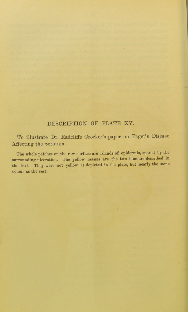 To illustrate Dr. Radcliffe Crocker's paper on Paget's Disease AfEecting the Scrotum. The whole patches on the raw surface are islands of epidermis, spared by the surrounding ulceration. The yellow masses are the two tumours described in the text. They were not yellow as depicted in the plate, but nearly the same colour as the rest.