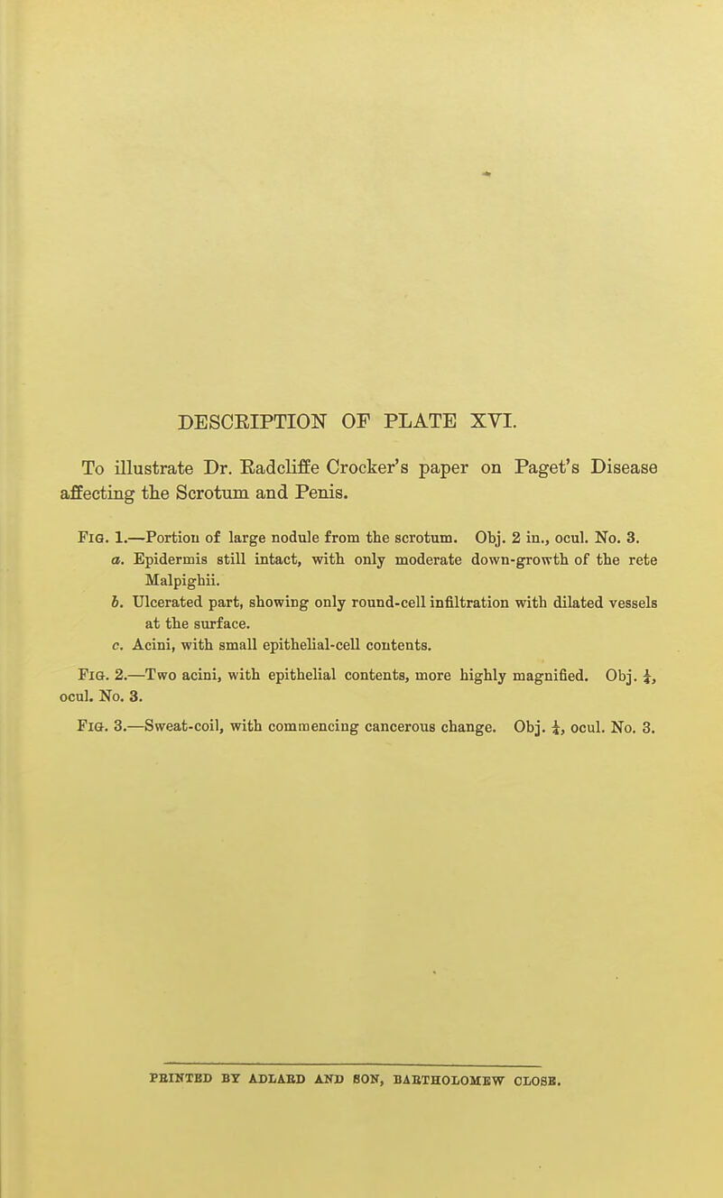 To illustrate Dr. Eadcliffe Crocker's paper on Paget's Disease affecting tlie Scrotum and Penis. Fig. 1.—Portion of large nodule from the scrotum. Obj. 2 in., ocul. No. 3. a. Epidermis still intact, with only moderate down-growth of the rete Malpighii. b. Ulcerated part, showing only round-cell infiltration with dilated vessels at the surface. c. Acini, with small epithelial-cell contents. Fig. 2.—Two acini, with epithelial contents, more highly magnified. Obj. i, ocul. No. 3. Fig. 3.—Sweat-coil, with commencing cancerous change. Obj. i, ocul. No. 3. FEINTED BY ADIiABS AND BON, BAETHOLOMBW CLOSB.