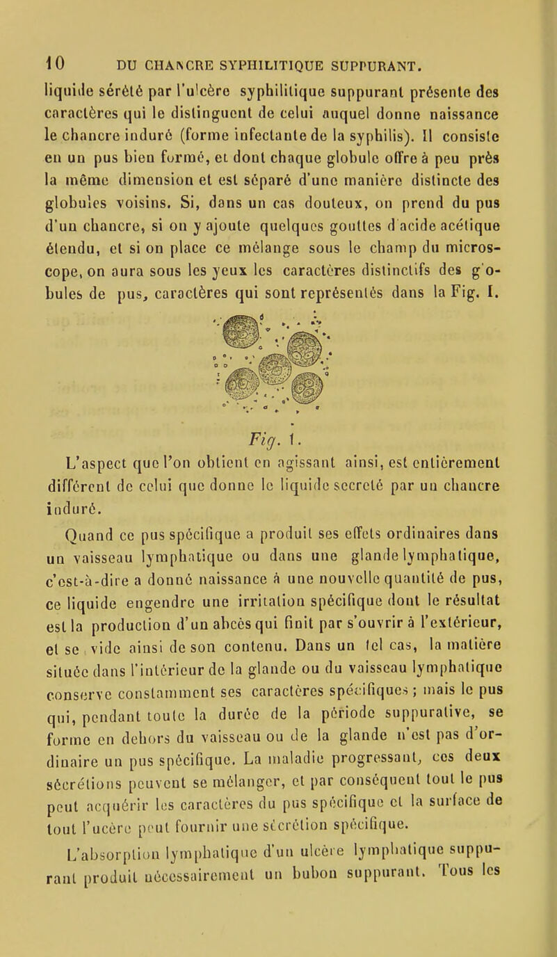 liquide sérélé par l'ulcère syphilitique suppurant présente de» caractères qui le distinguent de celui auquel donne naissance le chancre induré (forme infectante de la syphilis). Il consiste en un pus bien formé, et dont chaque globule offre à peu près la même dimension et est séparé d'une manière distincte des globules voisins. Si, dans un cas douteux, on prend du pus d'un chancre, si on y ajoute quelques gouttes d acide acétique étendu, et si on place ce mélange sous le champ du micros- cope, on aura sous les yeux les caractères distinclifs des g'o- bules de pus, caractères qui sont représentés dans la Fig. I. L'aspect que l'on obtient en agissant ainsi, est entièrement différent de celui que donne le liquide sccrelé par uu chantre induré. Quand ce pus spécifique a produit ses effets ordinaires dans un vaisseau lymphatique ou dans une glande lymphatique, c'est-à-dire a donné naissance â une nouvelle quantité de pus, ce liquide engendre une irritation spécifique dont le résultat est la production d'un abcès qui finit par s'ouvrir à l'extérieur, et se vide ainsi de son contenu. Dans un tel cas, la matière située dans l'intérieur de la glande ou du vaisseau lymphatique conserve constamment ses caractères spéi:ifique.s ; mais le pus qni, pendant toute la durée de la période suppuralive, se forme en dehors du vaisseau ou de la glande n'est pas d'or- diuaire un pus spécifique. La maladie progressant, ces deux sécrétions peuvent se mélanger, et par conséquent tout le pus peut acquérir les caractères du pus spécifique cl la surface de tout Tucère peut fournir une sécrétion spécifique. L'absorption lymphatique d'un ulcère lymphatique suppu- rant produit uécessaircmcut un bubon suppurant. Tous les