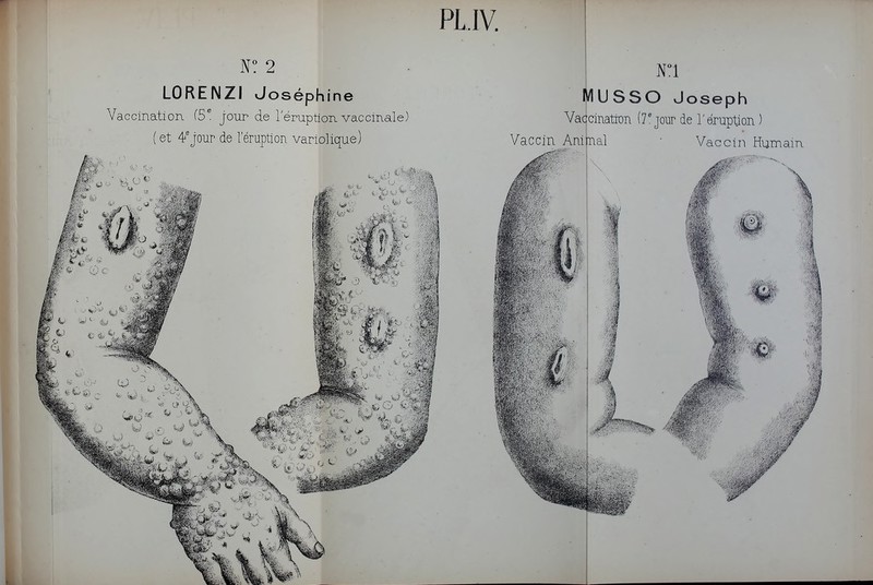 PLIV. N? 2 LORENZI Joséphine Vaccination (5^. jour de rémptionvaccinale) (et 4'jour de l'éruption variolique) MUSSO Joseph Va(|cination (7'jour de l'éruption ) Vaccin Animal • Vaccin Humam