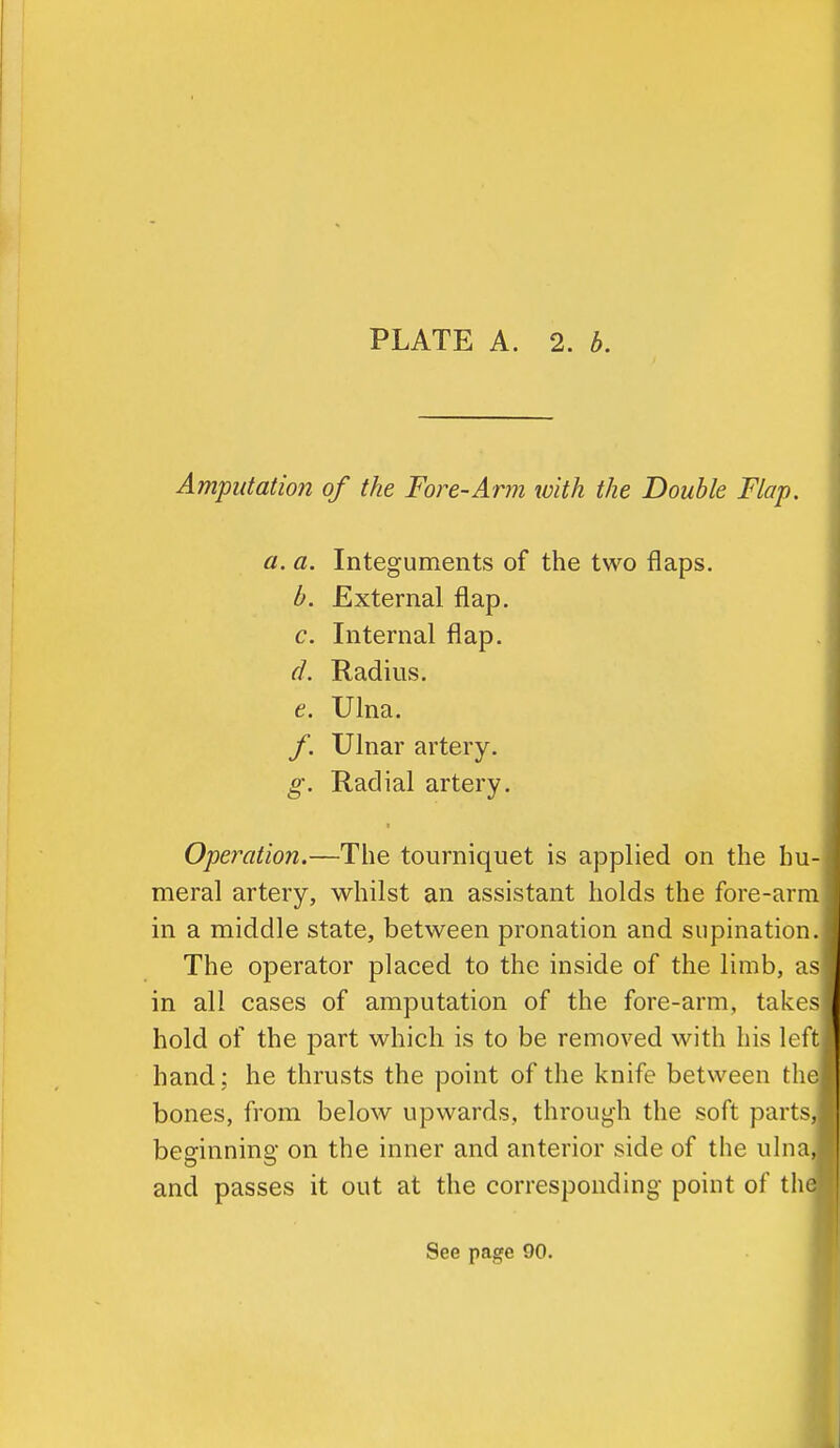 Amputation of the Fore-Arm with the Double Flap. a. a. Integuments of the two flaps. b. External flap. c. Internal flap. (L Radius. e. Ulna. f. Ulnar artery. g. Radial artery. Operation.—The tourniquet is applied on the hu- meral artery, whilst an assistant holds the fore-arm in a middle state, between pronation and supination. The operator placed to the inside of the limb, as in all cases of amputation of the fore-arm, takes hold of the part which is to be removed with his k^ft hand; he thrusts the point of the knife between tlio bones, from below upwards, through the soft parts, beginning on the inner and anterior side of the ulna, and passes it out at the corresponding point of the