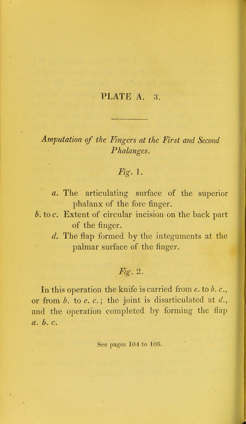 Amputation of the Fingers at the First and Second Phalanges. Fig. 1. a. The articulating surface of the superior phalanx of the fore finger. b. to c. Extent of circular incision on the back part of the finger. d. The flap formed by the integuments at the palmar surface of the finger. Fig. 2. In this operation the knife is carried from e. to b. c, or from b. to e. c; the joint is disarticulated at d., and the operation completed by forming the flap a. b. c.