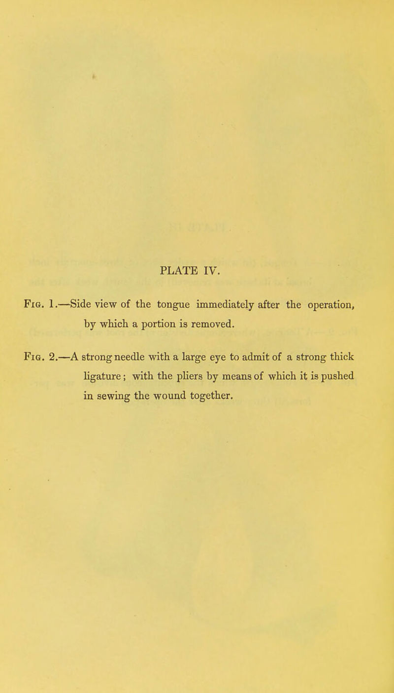 Fig. 1.—Side view of the tongue immediately after the operation, by which a portion is removed. Fig. 2.—A strong needle with a large eye to admit of a strong thick ligature; with the pliers by means of which it is pushed in sewing the wound together.