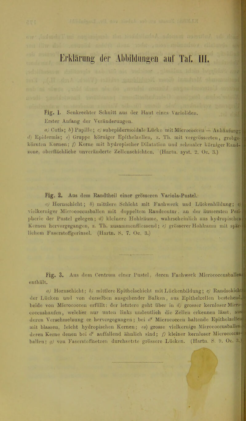 Erklärung der Abbildungen auf Tal'. III. Fig. 1. Senkrechter Schnitt aus der Haut eines Varioliden. Erster Anfang der Veränderungen. a) Cutis; b) Papille; cj subepidermoidale Lücke mit Micrococcen — Anhäufung« dt Epidermis; t) tiruppe körniger Epithelzellen, z. Th. mit vergrösserteu, grobe» körnten Kernen; f) Kerne mit hydropischcr Dilatation und schmaler körniger Kau« Kuue, oberflächliche unveränderte Zellenschichten. (Hartn. syst. 2. Oc. '.).) Fig. 2. Aus dem Randtheil einer grösseren Variola-Pustel. • ij Hornsohioht j 6) mittlere Schicht mit Fachwerk und Lüekenhildung; $ \ ii ikerniger Mirrococcusballcn mit doppeltem Kandcontur. au der äussersten Peri- pherie der Pustel gelegen; d) kleinere Hohlräume, wahrscheinlich aus hydropischen Kernen hervorgegangen. z. Th. zusanmienrliessend ; e) grösserer Hohlraum mit spär- lichem Faserstoflgerinsel. (Hartn. S. 7. Oc. 3.) Fig. 3. Aus dem Centrinu einer Pustel, deren Fach werk Mieröcocousballen enthält. a) Hornschicht: hj mittlere Epithelschicht mitLiickenbildung; cj Randsckieht der Lücken und von derselben ausgehender Balken, aus Epithelzellen bestehend) beide von Micrococcen erfüllt: der letztere geht über in d) grosser kernloser Micro- coccushaufen, welcher nur unten links undeutlich die Zellen erkennen liisst. ai* deren Verschmelzung er hervorgegangen; bei </' Micrococcen haltende Epithelzelleü mit blassen, leicht hydropischen Kernen; tu) grosse vielkernige Micrococcusballeu. dereu Kerne denen bei d' auffallend ähnlich sind; /) kleiner kernloser Micrococcus ballen; yj von Fasers(offnet/eu durchsetzte grössere Lücken. (Hartn. S. Ii. Oc. •'!..)