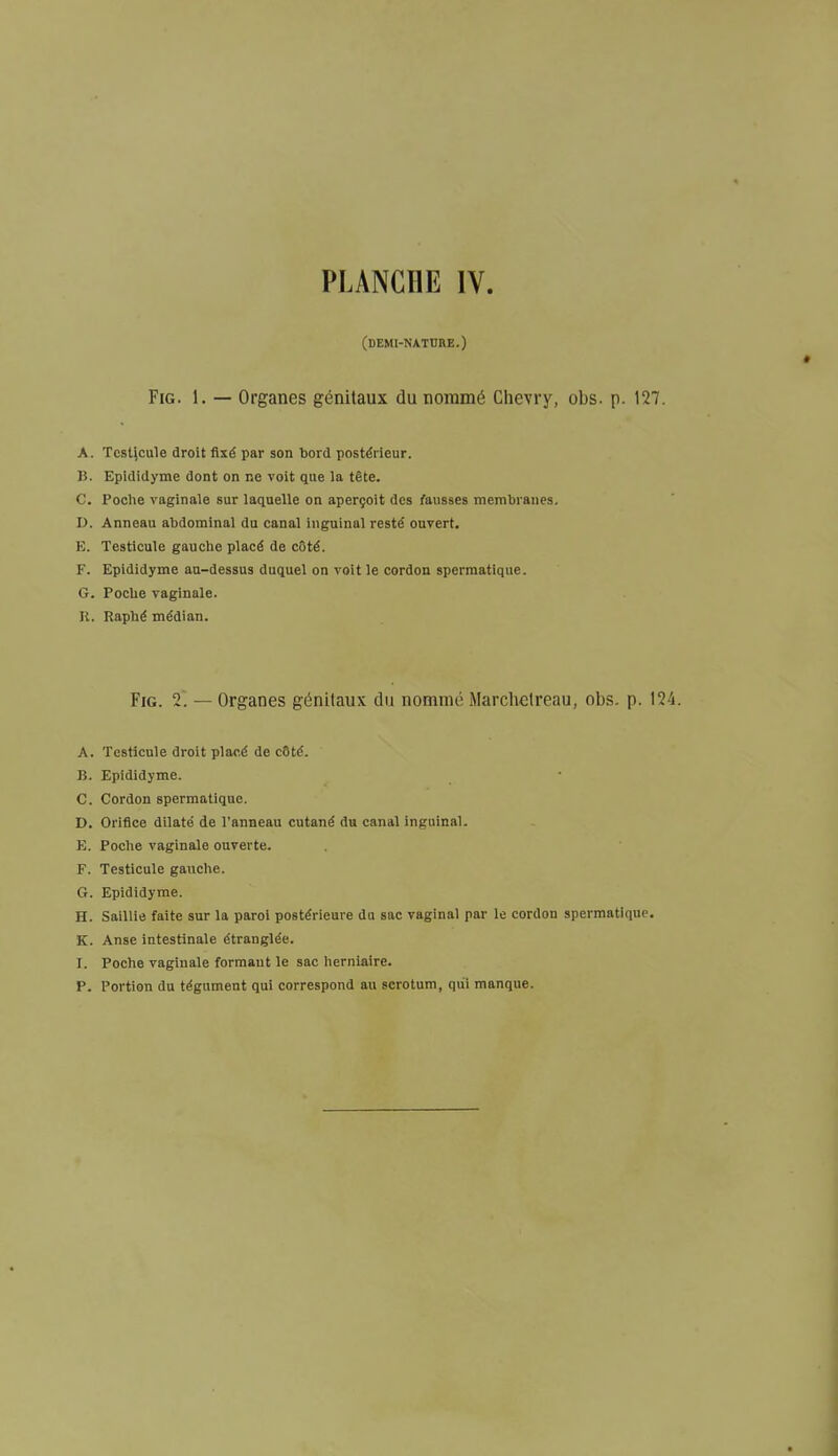 (demi-nature.) Fig. 1. — Organes génitaux du nommé Chevry, obs. p. 127. A. Testicule droit fixé par son bord postérieur. B. Epididyme dont on ne voit que la tète. C. Poche vaginale sur laquelle on aperçoit des fausses membranes. D. Anneau abdominal du canal inguinal resté ouvert. E. Testicule gauche placé de côté. F. Epididyme au-dessus duquel on voit le cordon spermatique. G. Poche vaginale. K. Raphé médian. Fig. 2. — Organes génitaux du nommé Marchctreau, obs. p. I2i. A. Testicule droit placé de côté. B. Epididyme. C. Cordon spermatique. D. Orifice dilaté de l'anneau cutané du canal inguinal. E. Poche vaginale ouverte. F. Testicule gauche. G. Epididyme. H. Saillie faite sur la paroi postérieure du sac vaginal par le cordon spermatique. K. Anse intestinale étranglée. I. Poche vaginale formant le sac herniaire. P. Portion du tégument qui correspond au scrotum, qui manque.