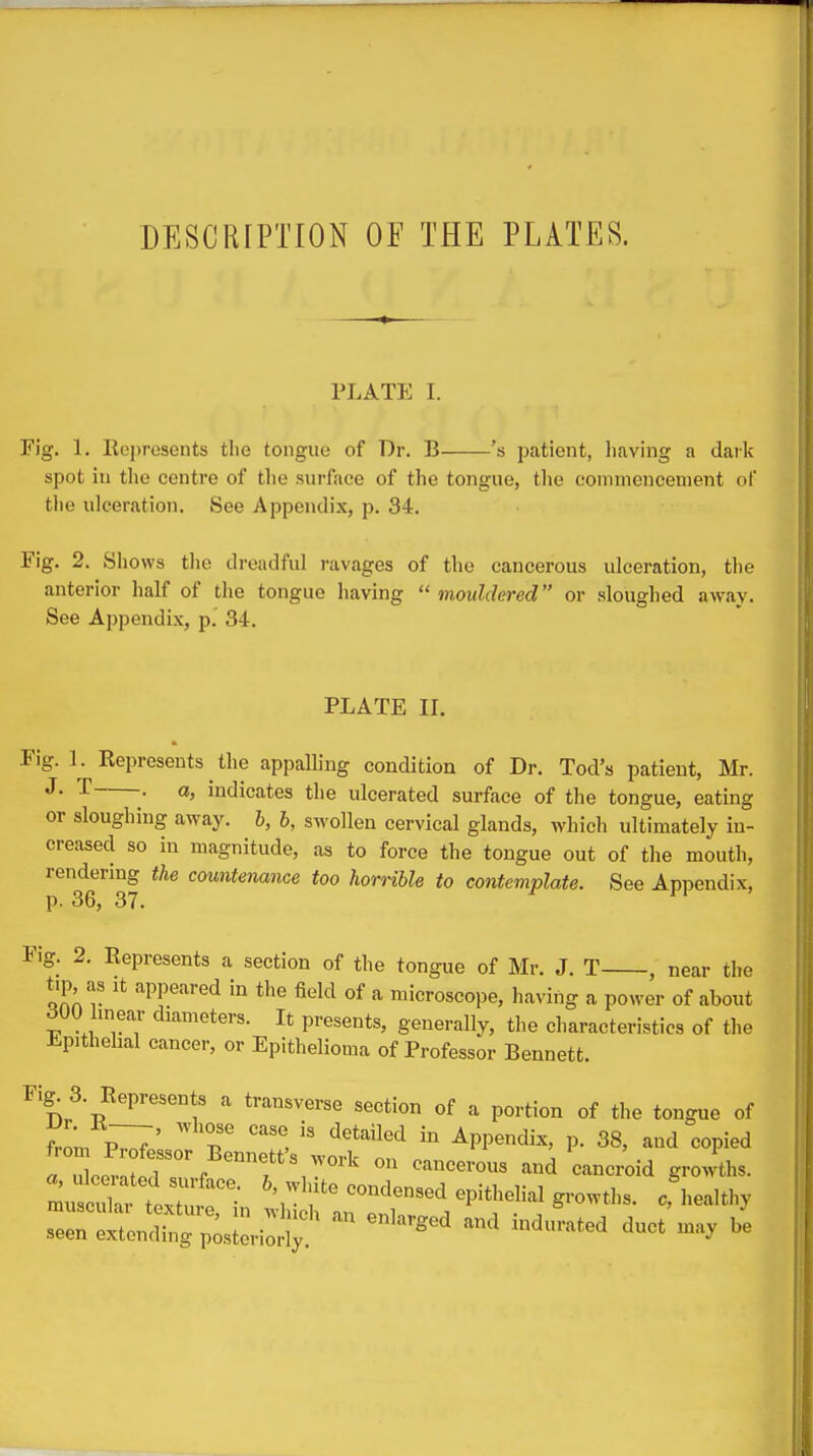 DESCRIPTION OF THE PLATES. PLATE I. Fig. 1. Represents tlie tongue of Dr. B 's patient, having a dark spot in the centre of the surface of the tongue, the commencement of the ulceration. See Appendix, p. 34. Fig. 2. Shows tlie dreadful ravages of the cancerous ulceration, the anterior half of the tongue having  mouldered or sloughed away. See Appendix, p. 34. PLATE IL Fig. 1. Represents the appalling condition of Dr. Tod's patient, Mr. ^- ^ • indicates the ulcerated surface of the tongue, eating or sloughing away, h, h, swollen cervical glands, whicli ultimately in- creased so in magnitude, as to force the tongue out of the mouth, rendering the countenance too homble to contemplate. See Appendix, p. 36, 37. Fig. 2. Represents a section of the tongue of Mr. J. T , near the tip as It appeared in the field of a microscope, liaving a power of about 300 Imear diameters. It presents, generally, the characteristics of the ii-pithelial cancer, or Epithelioma of Professor Bennett. Fig^ 3. Represents a transverse section of a portion of the tongue of from P^J' T Appendix, p. 38, and copied a le?.^7°% °f \'^ and cancroid growths. —tr?-. ti:i^;;t^:ri^^ri^^^^^ ^ '^^^'^^ seen extending p;steriorly ^'^^