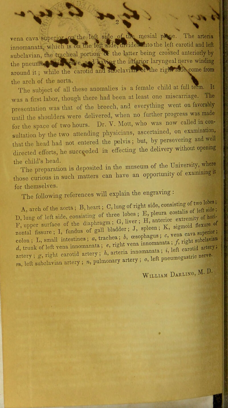 vena cava superiMgQ^he left siie oLiT^^n^ pl^jje. The arteria innomanata, wliicl^smi ifie left ^d^W'id^lihto the left carotid and left subclavian,'th(3 tmcheal portionH the latter being crossed anteriorly by the pneuirtQ#%Bf%e^ kTr^the iM™ laryngealnerve winding around it; wliile the carotid anS lUclavilW'the rigl•'#^^^^me from the arch of the aorta. m The subject of all these anomalies is a female child at full teTm. It was a first labor, though there had been at least one miscarriage. The presentation was that of the breech, and everything went on favorably until the shoulders were di^livered, when no further progress was made for the space of two hours. Dr. V. Mott, who was now caUed m con- sultation by the two attending physicians, ascertained, on exammation, that the head had not entered the palvis; but, by persevering and well directed efforts, he succeeded in effecting the delivery without opening ''t^ prIp-L is deposited in the museum of the University, >v^ere those curious in such matters can have an opportunity of exammu.gU for themselves. The following references will explain the engraving : A, avch of the aorta; B, heart; C, lung of right side, '^onslstrn, oH.^^^^^^^ | P, ling of lea Side, consisting of three lob. ; E P F, upper surface of the ^^^^f ' ^'^ T ' 3^;^^^^ sigmoid flexure of zontal fissure; I, fundus of gall bladder, J, spleen g colon; L, small intestines; «, trachea; b, '^^P^^S^^' ''7,°! sub lavian tru^k oV left vena innomanata; right vena -nomanata /, ngh aW; right carotid artery; ^^^^^^^^^^^^^^^^^^^^^ m, left subclavian artery ; n, pulmonary artery ; o, left pneumoga William Darling, M- D-