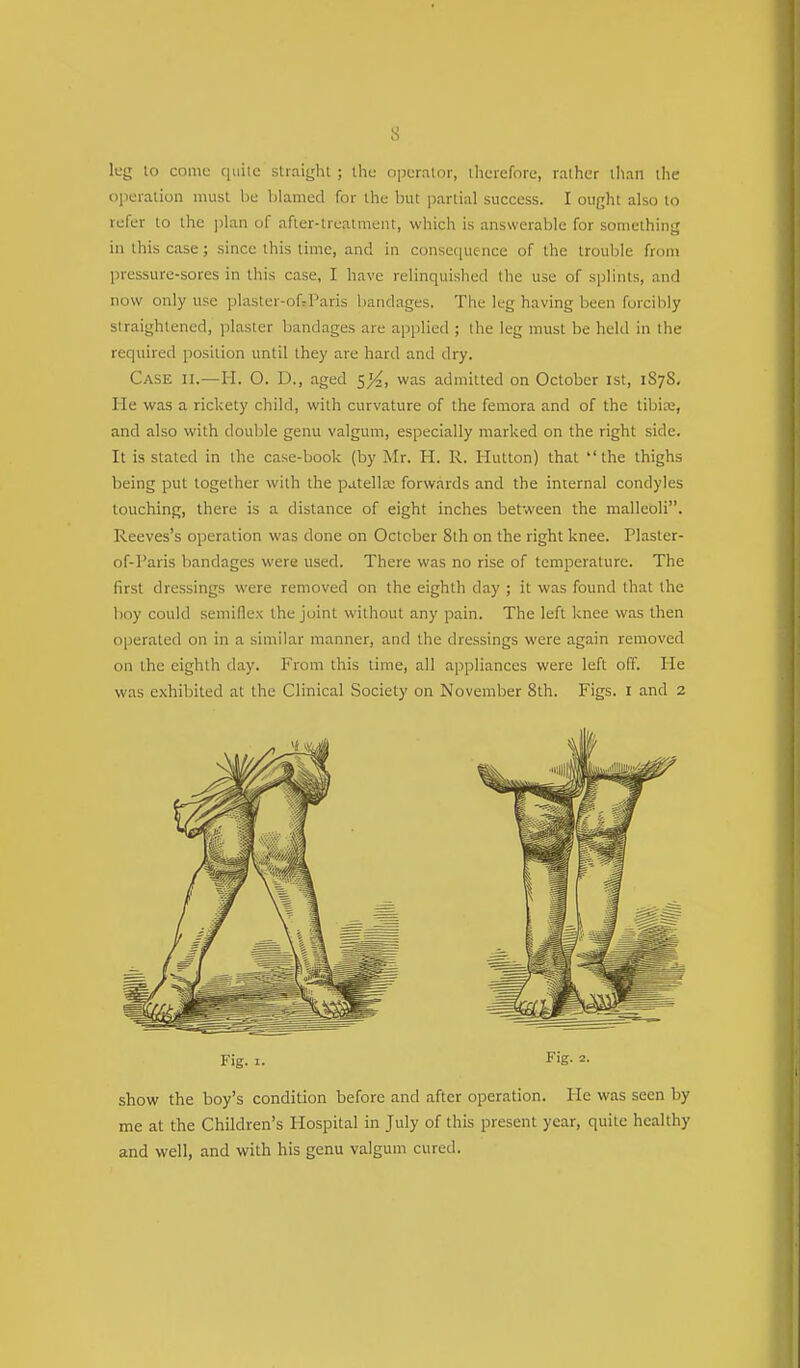 lug to conic quiic straight ; the operator, therefore, rather than the operation must he blamed for the but partial success. I ought also to refer to the plan of after-treatment, which is answerable for something in this case; since this time, and in consequence of the trouble from pressure-sores in this case, I have relinquished the use of splints, and now only use plaster-ofr Paris bandages. The leg having been forcibly straightened, plaster bandages are applied ; the leg must be held in the required position until they are hard and dry. Case ii.—H. O. D., aged ^/2, was admitted on October 1st, 1S7S. He was a rickety child, with curvature of the femora and of the tibia;, and also with double genu valgum, especially marked on the right side. It is stated in the case-book (by Mr. H. R. Hutton) that the thighs being put together with the patella: forwards and the internal condyles touching, there is a distance of eight inches between the malleoli. Reeves's operation was done on October 8th on the right knee. Plaster- of-Paris bandages were used. There was no rise of temperature. The first dressings were removed on the eighth day ; it was found that the boy could semiftex the joint without any pain. The left knee was then operated on in a similar manner, and the dressings were again removed on the eighth day. From this time, all appliances were left off. lie was exhibited at the Clinical Society on November 8th. Figs. I and 2 show the boy's condition before and after operation. He was seen by me at the Children's Hospital in July of this present year, quite healthy and well, and with his genu valgum cured. Fig. 1. Fig. 2.