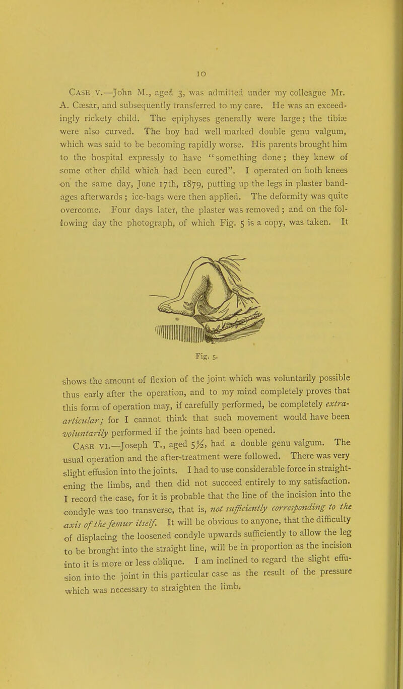 IO Cask v.—John M., aged 3, was admitted under my colleague Mr. A. Caesar, and subsequently transferred to my care. He was an exceed- ingly rickety child. The epiphyses generally were large; the tibia; were also curved. The boy had well marked double genu valgum, which was said to be becoming rapidly worse. His parents brought him to the hospital expressly 10 have something done; they knew of some other child which had been cured. I operated on both knees on the same day, June 17th, 1879, putting up the legs in plaster band- ages afterwards ; ice-bags were then applied. The deformity was quite overcome. Four days later, the plaster was removed ; and on the fol- Jowing day the photograph, of which Fig. 5 is a copy, was taken. It Fig. 5- shows the amount of flexion of the joint which was voluntarily possible thus early after the operation, and to my mind completely proves that this form of operation may, if carefully performed, be completely extra- articular; for I cannot think that such movement would have been ■voluntarily performed if the joints had been opened. Case vi.—Joseph T., aged SZA, had a double genu valgum. The usual operation and the after-treatment were followed. There was very slight effusion into the joints. I had to use considerable force in straight- ening the limbs, and then did not succeed entirely to my satisfaction. I record the case, for it is probable that the line of the incision into the condyle was too transverse, that is, not sufficiently corresponding to the axis of the femur itself. It will be obvious to anyone, that the difficulty of displacing the loosened condyle upwards sufficiently to allow the leg to be brought into the straight line, will be in proportion as the incision into it is more or less oblique. I am inclined to regard the slight effu- sion into the joint in this particular case as the result of the pressure which was necessary to straighten the limb.