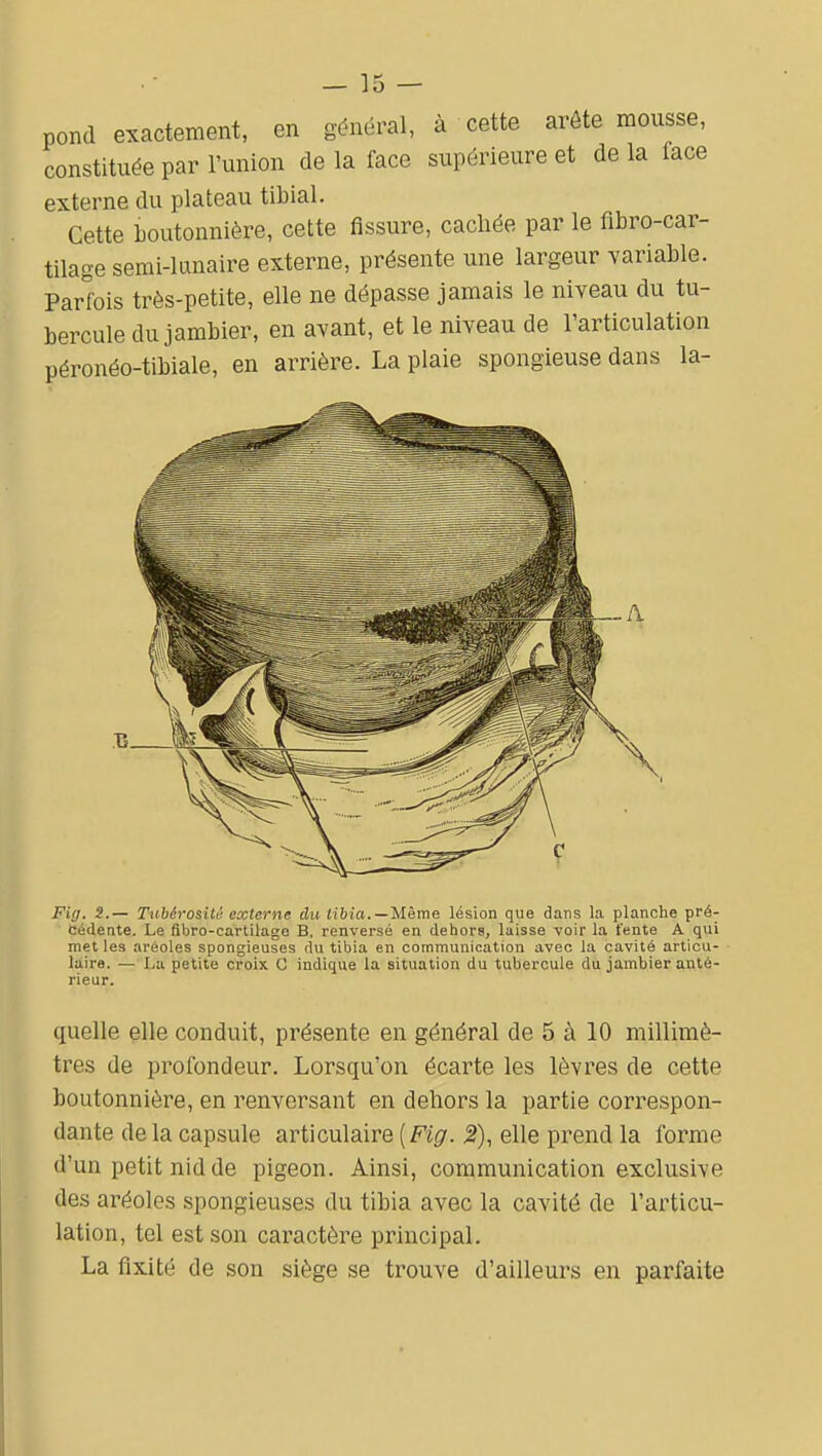 — 35 — pond exactement, en général, à cette arôte mousse, constituée par l'union de la face supérieure et delà lace externe du plateau tibial. Cette boutonnière, cette fissure, cachée par le fibro-car- tilage semi-lunaire externe, présente une largeur variable. Parfois très-petite, elle ne dépasse jamais le niveau du tu- bercule du jambier, en avant, et le niveau de l'articulation péronéo-tibiale, en arrière. La plaie spongieuse dans la- Fig. S.— Tubérositii externe du tibia. —Même lésion que dans la planche pré- cédeate. Le fibro-cartilage B, renversé en dehors, laisse voir la fente A qui met les aréoles spongieuses du tibia en communication avec la cavité articu- laire. — La petite croix G indique la situation du tubercule du jambier anté- rieur. quelle elle conduit, présente en général de 5 à 10 millimè- tres de profondeur. Lorsqu'on écarte les lèvres de cette boutonnière, en renversant en dehors la partie correspon- dante de la capsule articulaire (Fz^. 2), elle prend la forme d'un petit nid de pigeon. Ainsi, communication exclusive des aréoles spongieuses du tibia avec la cavité de l'articu- lation, tel est son caractère principal. La fixité de son siège se trouve d'ailleurs en parfaite