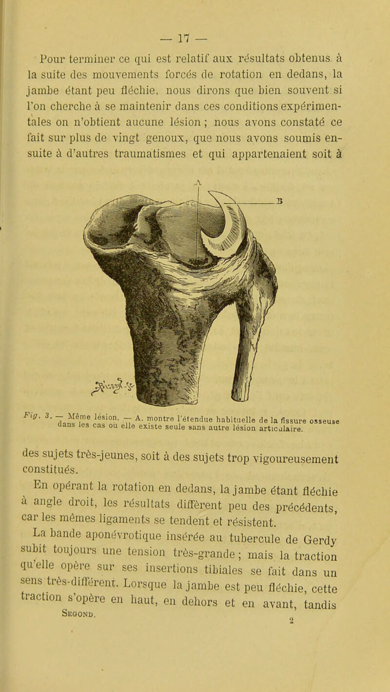 Pour terminer ce qui est relatif aux résultats obtenus à la suite des mouvements forcés de rotation en dedans, la jambe étant peu fléchie, nous dirons que bien souvent si l'on cherche à se maintenir dans ces conditions expérimen- tales on n'obtient aucune lésion ; nous avons constaté ce fait sur plus de vingt genoux, que nous avons soumis en- suite à d'autres traumatismes et qui appartenaient soit à des sujets très-jeunes, soit à des sujets trop vigoureusement constitués. En opérant la rotation en dedans, la jambe étant fléchie à angle droit, les résultats diff-èrent peu des précédents, car les mômes ligaments se tendent et résistent. La bande aponévrotique insérée au tubercule de Gerdy subit toujours une tension très-grande ; mais la traction qu'elle opère sur ses insertions tibiales se fait dans un sens très-difl-érent. Lorsque la jambe est peu fléchie, cette traction s'opère en haut, en dehors et en avant, tandis Segond. 2