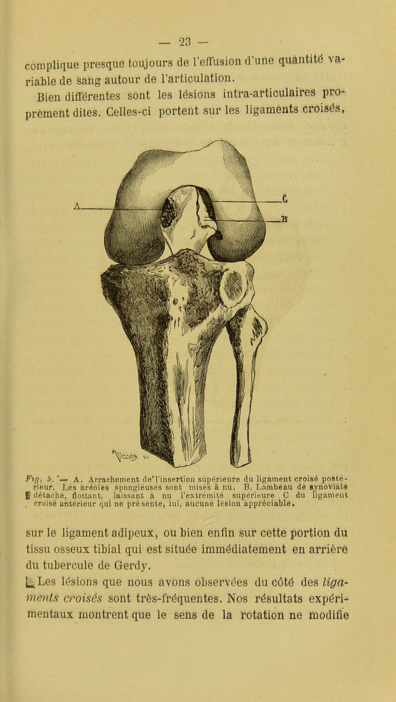 complique presque toujours de l'effusion d'une quantité va- riable de sang autour de l'articulation. Bien différentes sont les lésions intra-articulaires pro- prement dites. Celles-ci portent sur les ligaments croisés., Fig. 5.— A. Arrachement de'l'insertion supérieure du ligament croisé posté- rieur. Les aréoles spongieuses sont mises à nu. B. Lambeau de synoviale E détaché, flottant, laissant à nu l'extrémité supérieure C du ligament , croisé antérieur qui ne présente, lui, aucune lésion appréciable. sur le ligament adipeux, ou bien enfin sur cette portion du tissu osseux tibial qui est située immédiatement en arrière du tubercule de Gerdy. ^Les lésions que nous avons observées du côté des liga- ments croisés sont très-fréquentes. Nos résultats expéri-' mentaux montrent que le sens de la rotation ne modifie