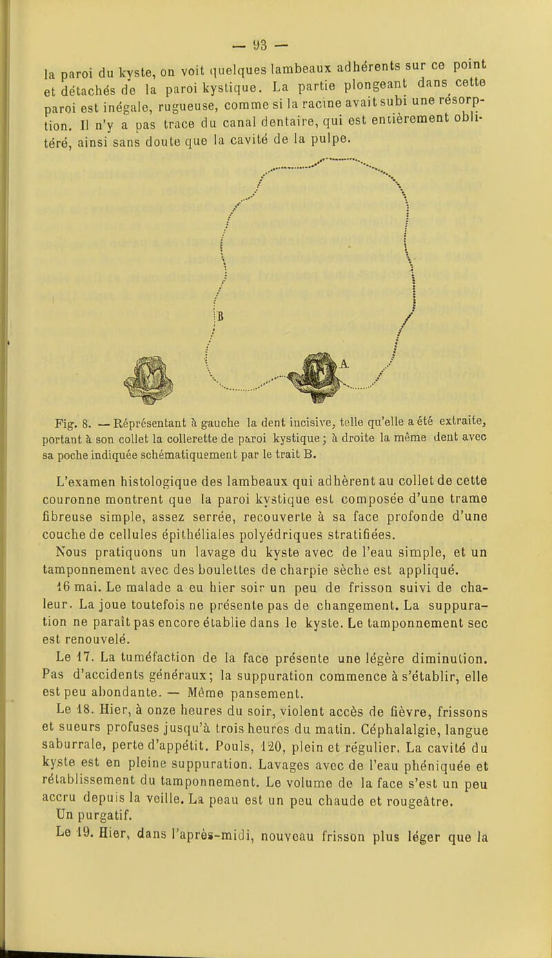 la paroi du kyste, on voit quelques et détachés de la paroi kystique, paroi est inégale, rugueuse, comme tion. Il n'y a pas trace du canal d téré, ainsi sans doute que la cavité lambeaux adhérents sur ce point La partie plongeant dans cette si la racine avait subi une résorp- entaire, qui est eniièrement obli- de la pulpe. Fig, 8. —Réprésentant à gauche la dent incisive^ telle qu'elle a été extraite, portant à son collet la collerette de paroi kystique ; à droite la même dent avec sa poche Indiquée schématiquement par le trait B. L'examen histologique des lambeaux qui adhèrent au collet de cette couronne montrent que la paroi kystique est composée d'une trame fibreuse simple, assez serrée, recouverte à sa face profonde d'une couche de cellules épilhéliales polyédriques stratifiées. Nous pratiquons un lavage du kyste avec de l'eau simple, et un tamponnement avec des boulettes de charpie sèche est appliqué. 16 mai. Le malade a eu hier soir un peu de frisson suivi de cha- leur. La joue toutefois ne présente pas de changement. La suppura- tion ne paraît pas encore établie dans le kyste. Le tamponnement sec est renouvelé. Le 17. La tuméfaction de la face présente une légère diminution. Pas d'accidents généraux; la suppuration commence à s'établir, elle est peu abondante. — Même pansement. Le 18. Hier, à onze heures du soir, violent accès de fièvre, frissons et sueurs profuses jusqu'à trois heures du matin. Céphalalgie, langue saburrale, perte d'appétit. Pouls, 120, plein et régulier. La cavité du kyste est en pleine suppuration. Lavages avec de l'eau phéniquée et rétablissement du tamponnement. Le volume de la face s'est un peu accru depuis la veille. La peau est un peu chaude et rougeâtre. Un purgatif. Le 19. Hier, dans l'après-midi, nouveau frisson plus léger que la