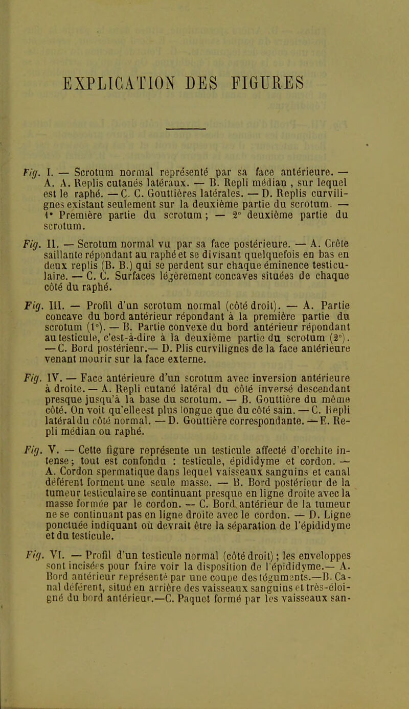 EXPLICATION DES FIGURES Firj. I. — Scrotum normal représenté par sa face antérieure. — A. A. Replis cutanés latéraux. — B. Repli médian , sur lequel est le raptaé. —C. C. Goutlières latérales. — D. Replis curvili- gnes existant seulement sur la deuxième partie du scrotum. — 4* Première partie du scrotum; — 2° deuxième partie du scrotum. Fig. II. — Scrotum normal vu par sa face postérieure. — A. Crête saillante répondant au raphéet se divisant quelquefois en bas en deux replis (B. B.) qui se perdent sur chaque éminence testicu- laire. — C. C. Surfaces légèrement concaves situées de chaque côté du raphé. Fig. III. — Profil d'un scrotum normal (côté droit). — A. Partie concave du bord antérieur répondant à la première partie du scrotum (1°). — B. Partie convexe du bord antérieur répondant au testicule, c'est-à-dire à la deuxième partie du scrotum (2°). — C. Bord postérieur.— D. Plis curvilignes de la face antérieure venant mourir sur la face externe. Fig. IV. — Face antérieure d'un scrotum avec inversion antérieure à droite. — A. Repli cutané latéral du côté inversé descendant presque jusqu'à la base du scrotum. — B. Gouttière du même côté. On voit qu'elleest plus longue que du côté sain. — C. liepli latéraldu côté normal. — D. Gouttière correspondante. —E. Re- pli médian ou raphé. Fig. V. — Cette figure représente un testicule affecté d'orchite in- tense; tout est confondu : testicule, épididyme et cordon. — A. Cordon spermatique dans lequel vaisseaux sanguins et canal déférent forment une seule masse. — B. Bord postérieur de la tumeur testiculairese continuant presque en ligne droite avec la masse formée par le cordon. — C. Bord, antérieur de la tumeur ne se continuant pas en ligne droite avec le cordon. — D. Ligne ponctuée indiquant où devrait être la séparation de l'épididymo et du testicule. Fig. VI. — Profil d'un testicule normal (côté droit) ; les enveloppes sont inciséi s pour faire voir la disposition de l'épididyme.— A. Bord antérieur représenté par une coupe des téguments.—B. Ca- nal défërent, situé en arrière des vaisseaux sanguins et trôs-éloi- gné du bord antérieur.—C. Paquet formé par les vaisseaux san-