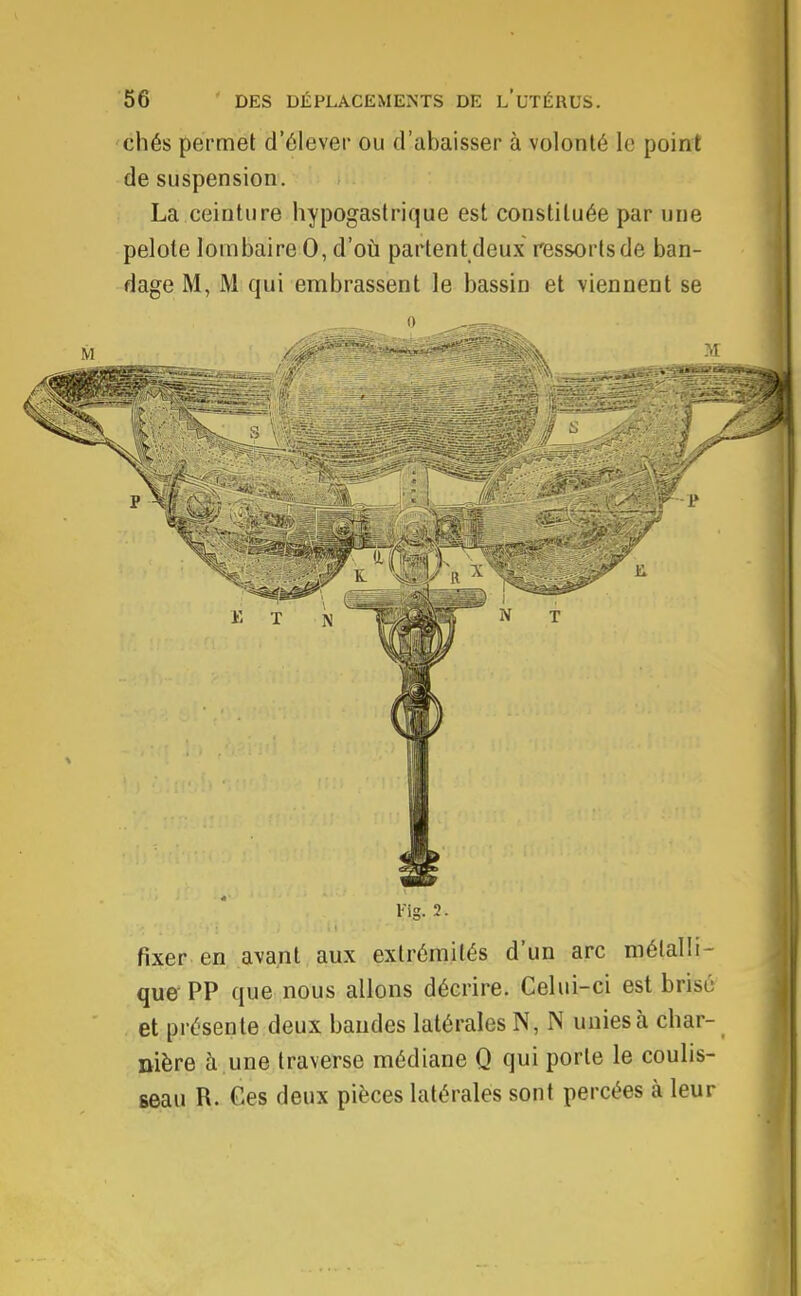 chés permet d'élever ou d'abaisser à volonté le point de suspension. La ceinture hypogastrique est constituée par une pelote lombaire 0, d'où partent deux ressorts de ban- dage M, M qui embrassent le bassin et viennent se fixer en avant aux extrémités d'un arc métalli- que PP que nous allons décrire. Celui-ci est brisé et présente deux bandes latérales N, N unies à char- nière à.une traverse médiane Q qui porte le coulis- seau R. Ces deux pièces latérales sont percées à leur