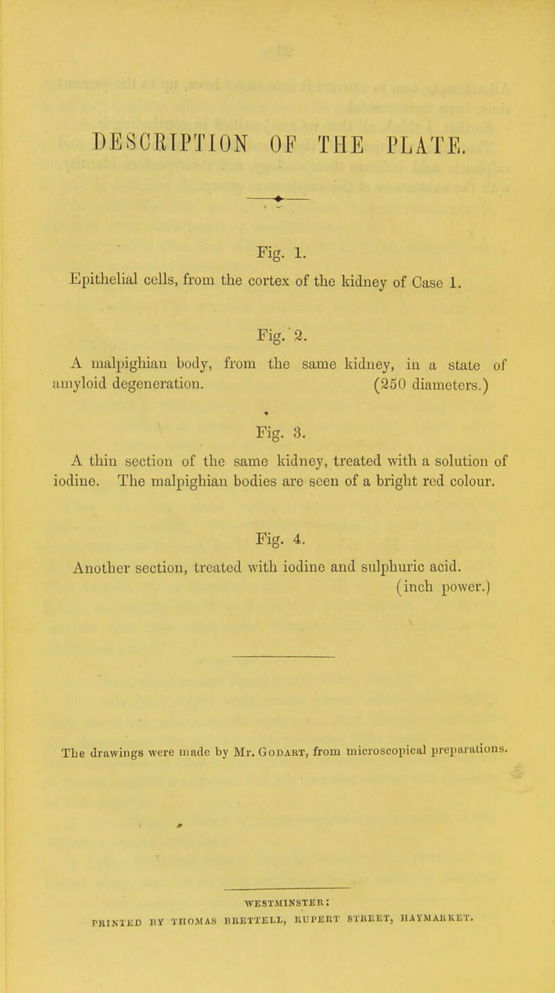 DESCRIPTION OF THE PLiTE. Fig. 1. Epithelial cells, from the cortex of the kidney of Case i. Fig.-2. A malpighiau body, from the same kidney, in a state of amyloid degeneration. (250 diameters.) Fig. 3. A thin section of the same kidney, treated with a solution of iodine. The malpighiau bodies are seen of a bright red colour. Fig. 4. Another section, treated with iodine and sulphuric acid. (inch power.) Tbe drawings were uiatlc by Mr. Godabt, from microscopical prepariilions. WESTMINSTEB : PBIKl'ED nr THOMAS BRETTELL, nUPEIlT STIIEET, HAVMAliKET.