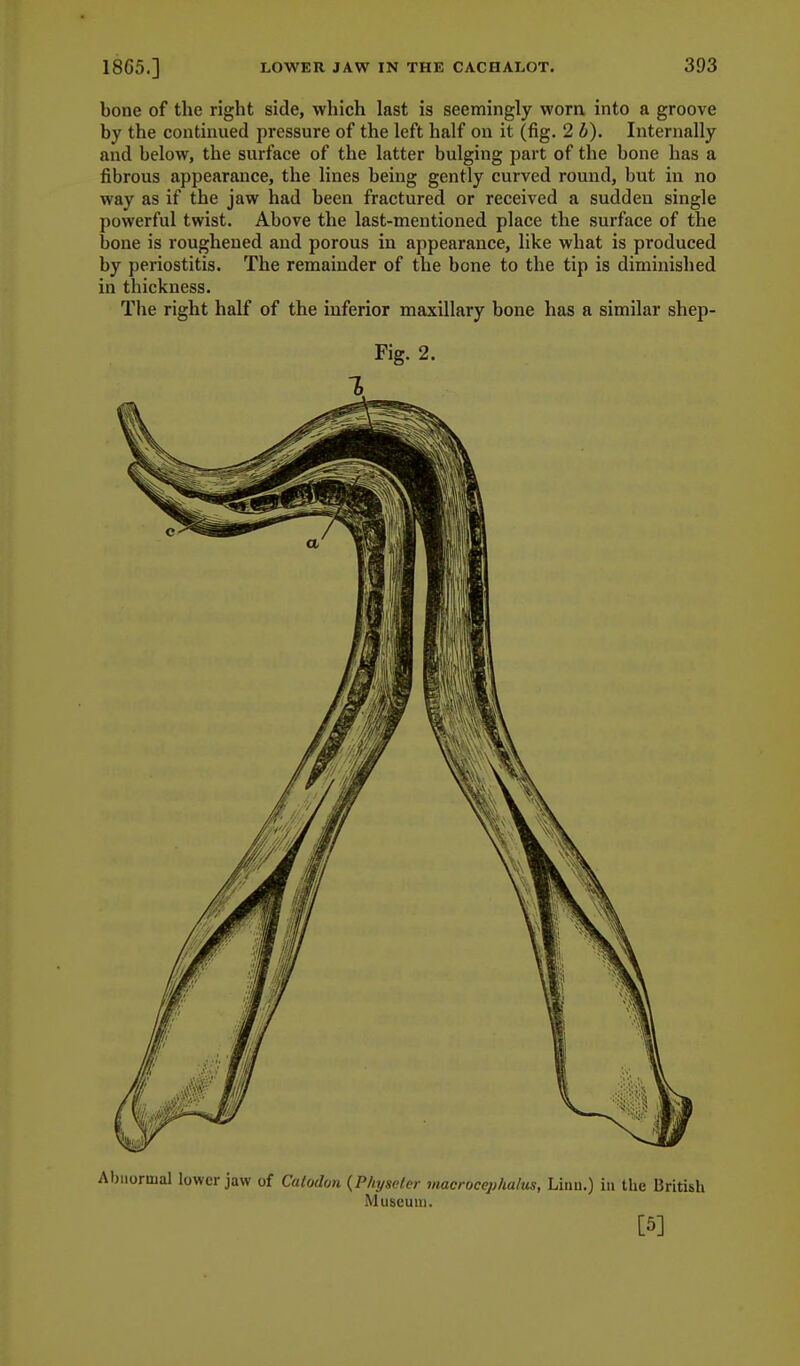 bone of the right side, which last is seemingly worn into a groove by the continued pressure of the left half on it (fig. 2 b). Internally and below, the surface of the latter bulging part of the bone has a fibrous appearance, the lines being gently curved round, but in no way as if the jaw had been fractured or received a sudden single powerful twist. Above the last-mentioned place the surface of the bone is roughened and porous in appearance, like what is produced by periostitis. The remainder of the bone to the tip is diminished in thickness. The right half of the inferior maxillary bone has a similar shep- Fig. 2. Abiiormal lower jaw of Calodon {Pliyseler macrocejjhalus, Linn.) in the British Museum. [5]