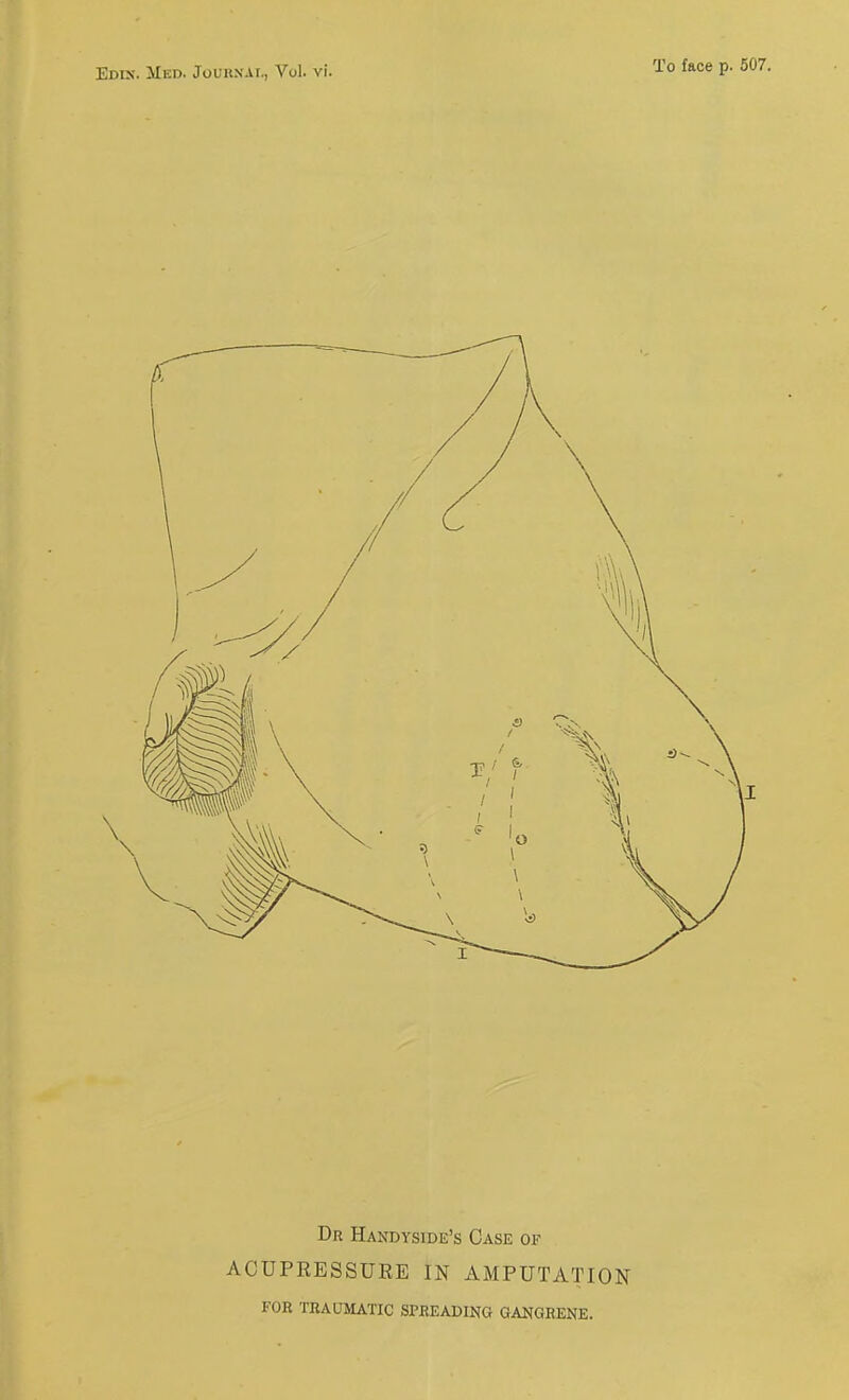 To face p. 507. Dr Handyside's Case of ACUPRESSURE IN AMPUTATION FOR TRAUMATIC SPREADING GANGRENE.