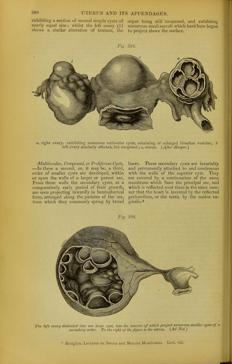 exhibiting a section of several simple cysts of organ being still unopened, and exhibiting nearly equal size ; wliilst the left ovary (i) numerous small sacculi which have here begun shows a similar alteration of texture, the to project above the surface. Fio;. 393. a, right ovary, exhibiting numerous unilocular cysts, consisting of enlarged Graafian vesicles; b left ovary similarly affected, but unopened ; c, uterus. {After Hooper.') MuUilocular, Compound, or Proliferous Cysts. —In these a second, or, it may be, a third, order of smaller cysts are developed, within or upon the walls of a larger or parent sac. From these walls the secondary cysts, at a comparatively early period of their growth, are seen projecting inwardly in hemispherical form, arranged along the parietes of the sac, from which they commonly spring by broad bases. These secondary cysts are invariably and permanently attached to and continuous with the walls of the superior cyst. They are covered by a continuation of the same membrane which lines the principal sac, and which is reflected over them in tiie same man- ner that the heart is invested by the reflected pericardium, or the testis by the tunica va- ginalis.* Fig. 394. T/ie left oeary dislendt sec ided into one large cyst, into the interior of which project numerous smaller cysts of u xondari/ order. 'To the right ofthefyurc is the uterus. (Ad Nat.) * Uudgliin, Lectures on Serous and Mucous Membranes. Lcct. viii.