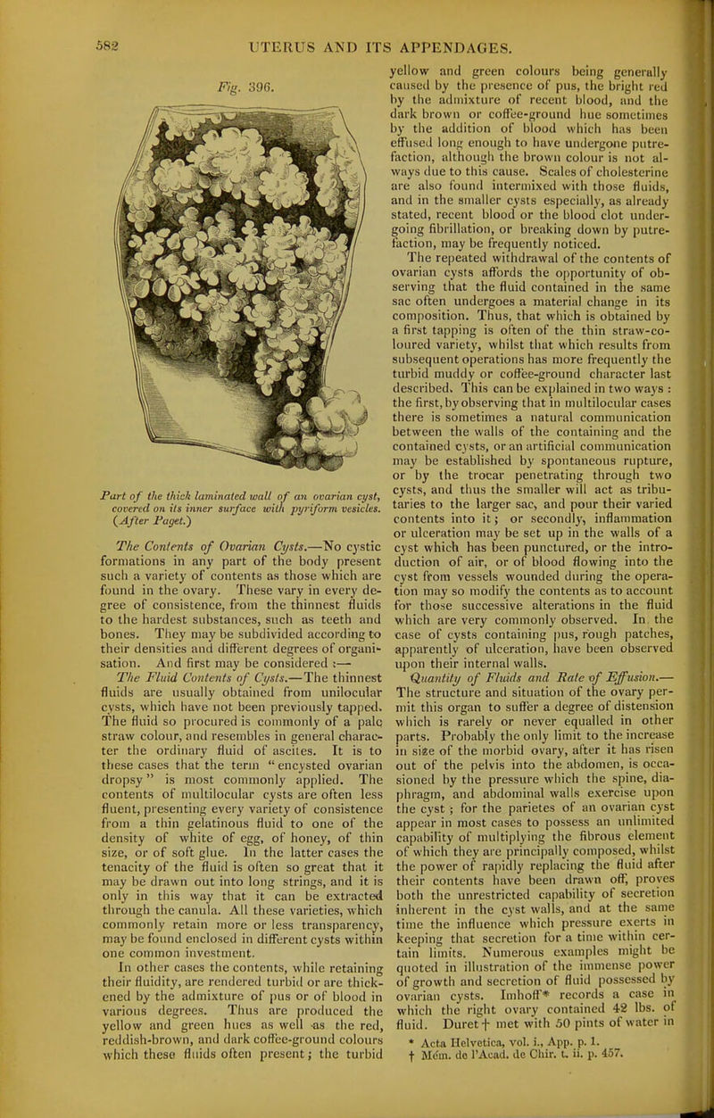 Fig. 396. Furt of the thick laminated wall of an ovarian cyst, covered on its inner surface with pyrifurm vesicles. (,After Faget.) The Co7i/ents of Ovarian Cysts.—No cystic formations in any part of the body present such a variety of contents as those which are found in the ovary. These vary in ever}' de- gree of consistence, from the thinnest fluids to the hardest substances, such as teeth and bones. They may be subdivided according to their densities and different degrees of organi- sation. And first may be considered :—- The Fluid Contents of Cysts.—The thinnest fluids are usually obtained from unilocular cysts, which have not been previously tapped. The fluid so procured is commonly of a pale straw colour, and resembles in general charac- ter the ordinary fluid of ascites. It is to these cases that the term  encysted ovarian dropsy is most commonly applied. The contents of multilocular cysts are often less fluent, presenting every variety of consistence from a thin gelatinous fluid to one of the density of white of egg, of honey, of thin size, or of soft glue. In the latter cases the tenacity of the fluid is often so great that it may be drawn out into long strings, and it is only in this way that it can be extracted through the canula. All these varieties, which commonly retain more or less transparency, may be found enclosed in different cysts within one common investment. In other cases the contents, while retaining their fluidity, are rendered turbid or are thick- ened by the admixture of pus or of blood in various degrees. Thus are produced the yellow and green hues as well -as the red, reddish-brown, and dark coffee-ground colours which these fluids often present; the turbid yellow and green colours being generally caused by the presence of pus, the bright red by the admixture of recent blood, and the dark brown or coffee-ground hue sometimes by the addition of blood which has been eff'used long enough to have undergone putre- faction, although the brown colour is not al- ways due to this cause. Scales of cholestcrine are also found intermixed with those fluids, and in the smaller cysts especially, as already stated, recent blood or the blood clot under- going fibrillation, or breaking down by putre- faction, may be frequently noticed. The repeated withdrawal of the contents of ovarian cysts affords the opportunity of ob- serving that the fluid contained in the same sac often undergoes a material change in its composition. Thus, that which is obtained by a first tapping is often of the thin straw-co- loured variety, whilst that which results from subsequent operations has more frequently the turbid muddy or coffee-ground character last described. This can be explained in two ways : the first, by observing that in multilocular cases there is sometimes a natural communication between the walls of the containing and the contained cysts, or an artificial communication may be established by spontaneous rupture, or by the trocar penetrating through two cysts, and thus the smaller will act as tribu- taries to the larger sac, and pour their varied contents into it; or secondly, inflammation or ulceration may be set up in the walls of a cyst which has been punctured, or the intro- duction of air, or of blood flowing into the cyst from vessels wounded during the opera- tion may so modify the contents as to account for those successive alterations in the fluid which are very commonly observed. In the case of cysts containing pus, rough patches, apparently of ulceration, have been observed upon their internal walls. Quantity of Fluids and Rate of Effusion.— The structure and situation of the ovary per- mit this organ to suffer a degree of distension which is rarely or never equalled in other parts. Probably the only limit to the increase in size of the morbid ovary, after it has risen out of the pelvis into the abdomen, is occa- sioned by the pressure which the spine, dia- phragm, and abdominal walls exercise upon the cyst ; for the parietes of an ovarian cyst appear in most cases to possess an unlimited capability of multiplying the fibrous element of which they are principally composed, whilst the power of rapidly replacing the fluid after their contents have been drawn off, proves both the unrestricted capability of secretion inherent in the cyst walls, and at the same time the influence which pressure exerts in keeping that secretion for a time within cer- tain limits. Numerous examples might be quoted in illustration of the immense power of growth and secretion of fluid possessed by ovarian cysts. Imhoff* records a case in which the right ovary contained 42 lbs. of fluid. Duretf met with 50 pints of water in * Acta Helvetica, vol. i., App. p. 1. t M($m. de I'Acad. de Chir. U ii. p. 457.