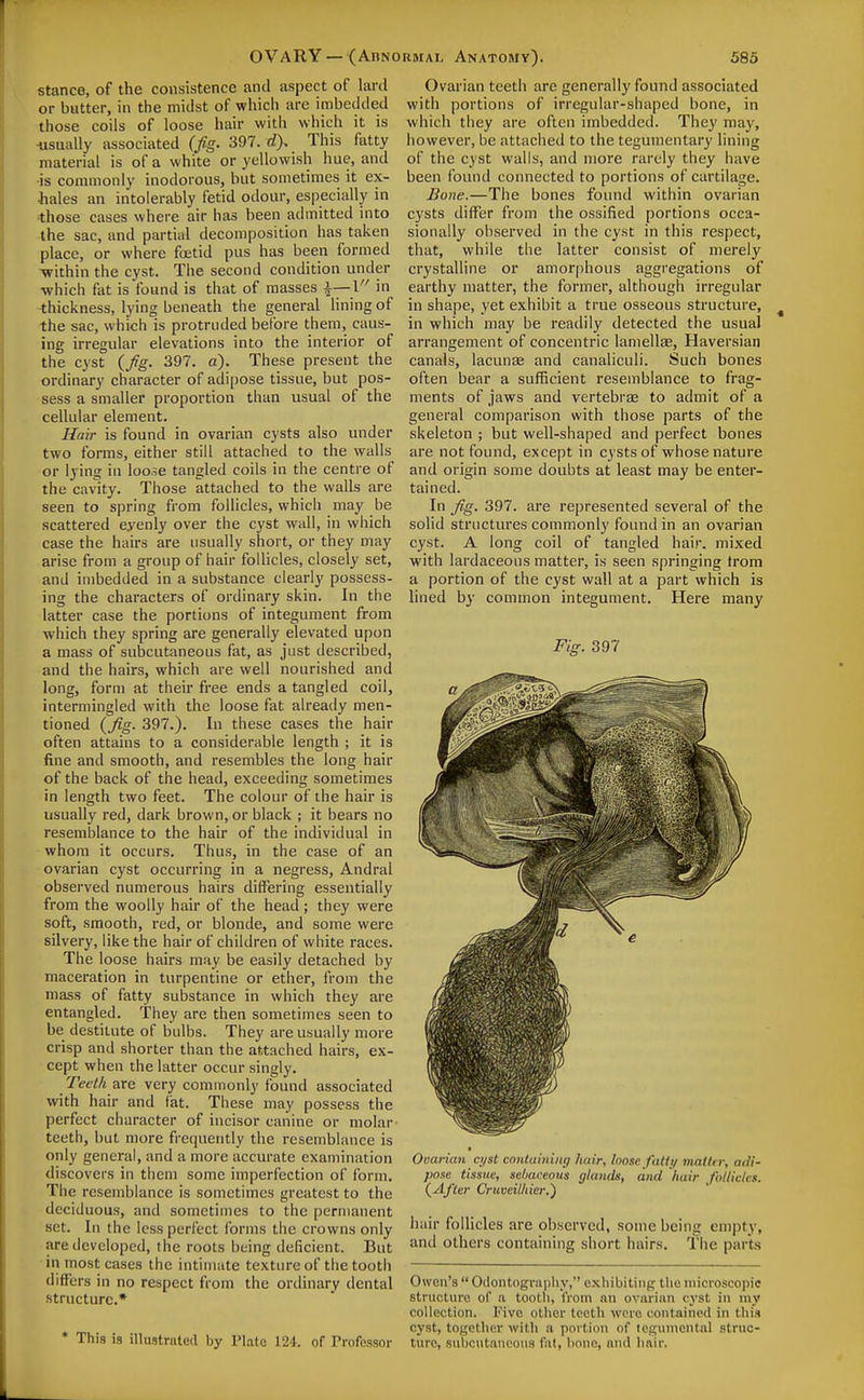 stance, of the consistence and aspect of lard or butter, in the midst of which are imbedded those coils of loose hair with which it is •usua lly associated (fig. 397. d). This fatty material is of a white or yellowish hue, and is commonly inodorous, but sometimes it ex- hales an intolerably fetid odour, especially in those cases where air has been admitted into the sac, and partial decomposition has taken place, or where foetid pus has been formed -within the cyst. The second condition under which fat is found is that of masses i—1 in thickness, lying beneath the general hning of the sac, which is protruded before them, caus- ing irregular elevations into the interior of the cyst {Jig. 397. a). These present the ordinary character of adipose tissue, but pos- sess a smaller proportion than usual of the cellular element. Hair is found in ovarian cysts also under two forms, either still attached to the walls or lying in loose tangled coils in the centre of the cavity. Those attached to the walls are seen to spring from follicles, which may be scattered eyenly over the cyst wall, in which case the hairs are usually short, or they may arise from a group of hair follicles, closely set, and imbedded in a substance clearly possess- ing the characters of ordinary skin. In the latter case the portions of integument from which they spring are generally elevated upon a mass of subcutaneous fat, as just described, and the hairs, which are well nourished and long, form at their free ends a tangled coil, intermingled with the loose fat already men- tioned {Jig. 397.). In these cases the hair often attains to a considerable length ; it is fine and smooth, and resembles the long hair of the back of the head, exceeding sometimes in length two feet. The colour of the hair is usually red, dark brown, or black ; it bears no resemblance to the hair of the individual in whom it occurs. Thus, in the case of an ovarian cyst occurring in a negress, Andral observed numerous hairs differing essentially from the woolly hair of the head ; they were soft, smooth, red, or blonde, and some were silvery, like the hair of children of white races. The loose hairs may be easily detached by maceration in turpentine or ether, from the mass of fatty substance in which they are entangled. They are then sometimes seen to be destitute of bulbs. They are usually more crisp and shorter than the attached hairs, ex- cept when the latter occur singly. Teeth are very commonly found associated with hair and fat. These may possess the perfect character of incisor canine or molar- teeth, but more frequently the resemblance is only general, and a more accurate examination discovers in them some imperfection of form. The resemblance is sometimes greatest to the deciduous, and sometimes to the permanent set. In the less perfect forms the crowns only are developed, the roots being deficient. But in most cases the intimate texture of the tooth differs in no respect from the ordinary dental structure.* * This is illustrated by Plato 124. of Professor Ovarian teeth are generally found associated with portions of irregular-shaped bone, in which they are often imbedded. They may, however, be attached to the tegumentary lining of the cyst walls, and more rarely they have been found connected to portions of cartilage. Bone.—The bones found within ovarian cysts differ from the ossified portions occa- sionally observed in the cyst in this respect, that, while the latter consist of merely crystalline or amorphous aggregations of earthy matter, the former, although irregular in shape, yet exhibit a true osseous structure, in which may be readily detected the usual arrangement of concentric lamellae. Haversian canals, lacunEE and canaliculi. Such bones often bear a sufficient resemblance to frag- ments of jaws and vertebras to admit of a general comparison with those parts of the skeleton ; but well-shaped and perfect bones are not found, except in cysts of whose nature and origin some doubts at least may be enter- tained. In fig. 397. are represented several of the solid structures commonly found in an ovarian cyst. A long coil of tangled hair, mixed with lardaceous matter, is seen springing trora a portion of the cyst wall at a part which is lined by common integument. Here many Fig. 397 Ovarian cyst containing hair, loose fatty matter, adi- pose tissue, schaceous glands, and hair follicles. (^Afier Cruveilhier.') iiair follicles are observed, some being empty, and others containing short hairs. The parts OwoTi's  0(iontngva|)h_v, exliibitiiip; tlie iiiici'osco|)i<J structure of a tootli, tVom an ovarian cyst in my collection. Five other teeth wore coutained in this cyst, together with a portion of teguiiiental struc- ture, subcutaneous fat, hone, and hair.