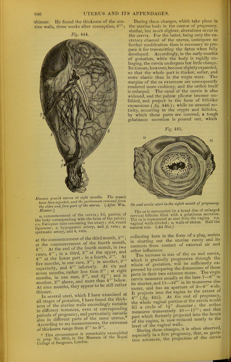 thinner. He found the thickness of the ute- rine walls, three weeks after conception, C'; Fin. 444.. During these changes, which take place in the uterine body in tlie course of pregnancy, similar, hut much slighter, alterations occur in the cervix. For the latter, being only the ex- cretory channel of the uterus, undergoes no further mollification than is necessary to pre- pare it for transmitting the foetus when fully developed. Accordingly, in the early months of gestation, while the body is rapidly en- larging, the cervix undergoes but little change. Its tissues, how ever, become slightly expanded, so that the whole part is thicker, softer, and more elastic than in the virgin state. The margins of the os externum are consequently rendered more cushiony, and the orifice itself is enlarged. The canal of the cervix is also widened, and the palmse plicatae become un- folded, and project in the form of frill-like expansions (Jig. 446.) ; while an unusual ac- tivity, occurring in the crypts and follicles, by which these parts are covered, a tough gelatinous secretion is poured out, which Fig. 445. JHuinan gravid uterus at eight months. The vessels have been injected, and the peritoneum removed Jrom the sides and fore-part of the uterus. {After m. Hunter.) a, commencement of the cervix; bb, portion of the body corresponding with the brim of the pelvis; cc. Fallopian tube concealing the ovary; drf, round ligament; e, hypogastric artery, and /, vem; g, spermatic artery, and h, vein. at the commencement of the third month, 5' ; at the commencement of the fourth month, 4' At the end of the fourth month, m two cases, 4'; in a third, 3' at the upper, and 4' at the lower part; in a fourth, o . At five months, in one case, 3'; in another, 2 superiorly, and 4' infcriorly. At six and seven months, rather less than 3 ; at eight months, in one case, 2', and 2^ ;,ad m another, 3' above, and more than 4' below. At nine months, they appear to be still rather thinner. , ^ , • i In several uteri, which I have examined at all stages of gestation, I have found the thick- ness of the uterine walls exceeihngly variable in different instances, even at corresponding periods of pregnancy, and particularly variable also in different parts of the same uterus. According to my measurements, the extremes of thickness range from 2' to 9'. » This circumstance is remarkably exemplified in prep. No. 3605, in the Museum of the Hoyal College of Surgeons, London. Os and cervix uteri in the eighth month of pregnancy. The 03 is surrounded by a broad disc of enlarged cervical follicles filled with a gelatinous secretion. The OS is represented as seen from the vagina, ca, vaginal walls divided ; u, walls of uterus. Half the natural size. {Ad Nat.) collecting here in the form of a plug, assists in shutting out the uterine cavity and its contents from contact of external au- and other influences. The increase in size of the os and cervix, which is gradually progressive through the whole of gestation, will be sufficiently ex- pressed by comparing the dimensions of these parts in their two extreme states. Thevirgm cervix measures usually at the base 7—8 in its shorter, and 11-12' in its transverse dia- meter, and has an aperture of 3—4 wide. It projects into the vagina to the extent of 4' 425). At the end of pregnancy, the whole vaginal portion of the cervix would fill a circle of H diameter ; the orifice measures transversely 10-11'; and that part which formerly projected into tlie foi mx of the vagina, is now reduced nearly to the level of the vaginal walls. • During these changes, it is often observed, es|,ecially iu a first pregnancy, that as gesta- tion advances, the projection of the ceiux