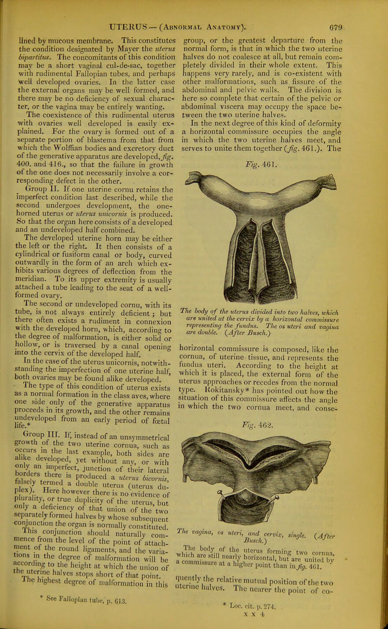 lined by mucous membrnne. This constitutes the condition designated by Mayer the utmts bipartiltcs. The concomitants of this condition may be a short vaginal cul-de-sac, together with rudiniental Fallopian tubes, and perhaps well developed ovaries. In the latter case the external organs may be well formed, and there may be no deficiency of sexual charac- ter, or the vagina may be entirely wanting. The coexistence of this rudimental uterus with ovaries well developed is easily ex- plained. For the ovary is formed out of a separate portion of blastema from that from which the Wolffian bodies and excretory duct of the generative apparatus are developed, 400. and 416., so that the failure in growth of the one does not necessarily involve a cor- responding defect in the other. Group II. If one uterine cornu retains the imperfect condition last described, while the second undergoes development, the one- horned uterus or uterus unicornis is produced. So that the organ here consists of a developed and an undeveloped half combined. The developed uterine horn may be either the left or the right. It then consists of a cylindrical or fusiform canal or body, curved outwardly in the form of an arch which ex- hibits various degrees of deflection from the meridian. To its upper extremity is usually attached a tube leading to the seat of a well- formed ovary. The second or undeveloped cornu, with its tube, is not always entirely deficient ; but there often exists a rudiment in connexion with the developed horn, which, according to the degree of malformation, is either solid or hollow, or is traversed by a canal opening into the cervix of the developed half. In the case of the uterus unicornis, notwith- standing the imperfection of one uterine half, both ovaries may be found alike developed. The type of this condition of uterus exists as a normal formation in the class aves, where one side only of the generative apparatus proceeds m its growth, and the other remains undeveloped from an early period of foetal Group III. If, instead of an unsymmetrical growth of the two uterine cornua, such as occurs m the last example, both sides are alike developed, yet without anv, or with only an imperfect, junction of their lateral borders there is produced a uterus fee, p ex; Here however there is no evidence of p urahty or true duplicity of the utJIus but only a deficiency ot that union of the two separately formed halves by whose subsequent conjunction the organ is normally constituted 1 his conjunction should naturally com- mence from the level of the point of attach- ment of the round ligaments, and the varia- tions m the degree of malformation will be according to the height at which the union of the uterine halves stops short of that point. Ihc highest degree of malformation in this * See Fallopian (ubc, p. 613. group, or the greatest departure from the normal form, is that in which the two uterine halves do not coalesce at all, but remain com- pletely divided in their whole extent. This happens very j-arely, and is co-existent with other malformations, such as fissure of the abdominal and pelvic walls. The division is here so complete that certain of the pelvic or abdominal viscera may occupy the space be- tween the two uterine halves. In the next degree of this kind of deformity a horizontal commissure occupies the angle in which the two uterine halves meet, and serves to unite them together (^Jig. 461.). The Fig. 461. Tlie body of the uterus divided into two halves, which are united at the cervix 1)1/ a horizontal commissure representing the fundus. The os uteri and vagina are double. (^After Busch.) horizontal commissure is composed, like the cornua, of uterine tissue, and represents the fundus uteri. According to the height at which it is placed, the external form of the uterus approaches or recedes from the normal type. Hokitansky* has pointed out how the situation of this commissure affects the ani>le in which the two cornua meet, and conse- singk. {After The vagina, os uteri, and cervi.v, ■Busch.) The body of the uterus formini: two cornin a commissuie at a higlier point than in fg. 461. uSn'/lI'T '■^'^t'l?'*'^' P««5tion of the two tcrine halves. The nearer the point of co- * Loc. cit. p. 274.