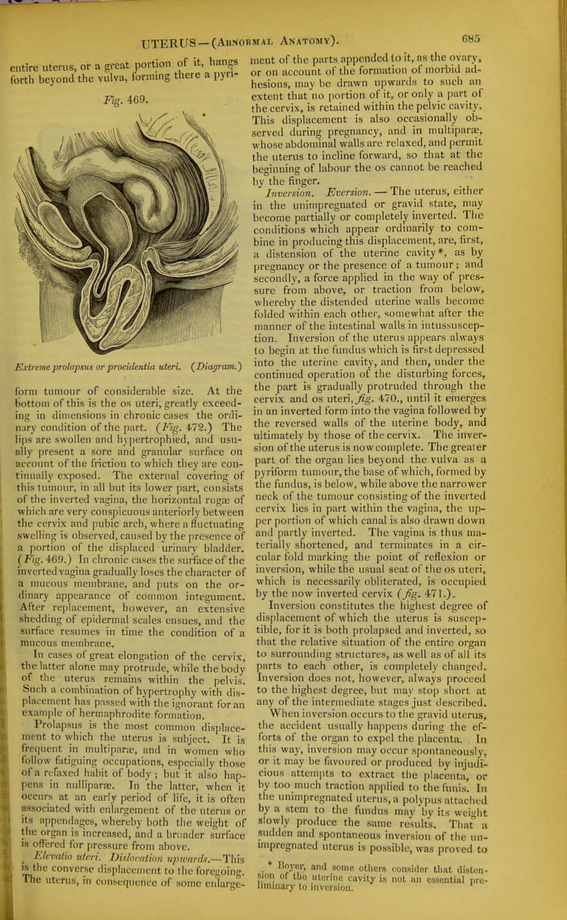 UTERUS —(Anr entire uterus, or a great portion of it, hangs forth beyond the vulva, forming there a pyri. Fig. 469. Extreme prolapsus or procidentia uteri, {Diagram.') form tumour of considerable size. At the bottom of this is the os uteri, greatly exceed- ing in dimensions in chronic cases the ordi- nary condition of the part. 472.) The lips are swollen and h} pertrophied, and usu- ally present a sore and granular surface on account of the friction to which they are con- tinually exposed. The external covering of this tumour, in all but its lower part, consists of the inverted vagina, the horizontal rugae of which are very conspicuous anteriorly between the cervix and pubic arch, where a fluctuating swelling is observed, caused by the presence of a portion of the displaced urinary bladder. (Fig. 469.) In chronic cases the surface of the inverted vagina gradually loses the cliaracter of a mucous membrane, and puts on the or- dinary appearance of common integument. After replacement, however, an extensive shedding of epidermal scales ensues, and the surface resumes in time the condition of a mucous membrane. In cases of great elongation of the cervix, the latter alone may protrude, while the body of the uterus remains within the pelvis. Such a combination of hypertrophy with dis- placement has passed with the ignorant for an Exam|)le of hermaphrodite formation. Prolapsus is the most common displace- ment to which the uterus is subject. It is frequent in multipara;, and in women who follow fatiguing occupations, especially those of a refaxed habit of body ; but it also hap- pens in nulliparae. In the latter, when it occurs at an early period of life, it is often associated with enlargement of the uterus or its appendages, whereby both the weight of the organ is increased, and a broader surface IS offered for pressure from above. ^ Elcvatio idcri. Didncfttion upward-i.—Thh IS the converse displacement to the foregoing. The uterus, in con.sequcnce of some enlargc- iMAL Anatomy). 685 nient of the parts appended to it, ns the ovary, or on account of the formation of morbid ad- hesions, may be drawn upwards to such an extent that no portion of it, or only a part of the cervix, is retained within the pelvic cavity. This displacement is also occasionally ob- served during pregnancy, and in multiparae, whose abdominal walls are relaxed, and permit the uterus to incline forward, so that at the beginning of labour the os cannot be reached by the finger. Inversion. Eversion. — The uterus, either in the unimpregnated or gravid state, may become partially or completely inverted. The conditions which appear ordinarily to com- bine in producing this displacement, are, first, a distension of the uterine cavity*, as by pregnancy or the presence of a tumour; and secondly, a force applied in the way of pres- sure from above, or traction from below, whereby the distended uterine walls become folded within each other, somewhat after the manner of the intestinal walls in intussuscep- tion. Inversion of the uterus appears always to begin at the fundus which is first depressed into the uterine cavity, and then, under the continued operation of the disturbing forces, the part is gradually protruded through the cervix and os uteri, Jig. 470., until it emerges in an inverted form into the vagina followed by the reversed walls of the uterine body, and ultimately by those of the cervix. The inver- sion of the uterus is nowcomplete. The greater part of the organ lies beyond the vulva as a pyriform tumour, the base of which, formed by the fundus, is below, while above the narrower neck of the tumour consisting of the inverted cervix lies in part within the vagina, the up- per portion of which canal is also drawn down and partly inverted. The vagina is thus ma- terially shortened, and terminates in a cir- cular fold marking the point of reflexion or inversion, while the usual seat of the os uteri, which is necessarily obliterated, is occupied by the now inverted cervix (Jig. 471.). Inversion constitutes the highest degree of displacement of which the uterus is suscep- tible, for it is both prolapsed and inverted, so that the relative situation of the entire organ to surrounding structures, as well as of all its parts to each other, is completely changed. Inversion does not, however, always proceed to the highest degree, but may stop short at any of the intermediate stages just described. When inversion occurs to the gravid uterus, the accident usually happens during the ef- forts of the organ to expel the placenta. In this way, inversion may occur spontaneously, or it may be favoured or produced by injudi- cious attempts to extract the placenta, or by too much traction applied to the funis. In the unimpregnated uterus, a polvpus attached by a stem to the fundus may by its weight slowly produce the same results. That a sudden and spontaneous inversion of the un- mipregnated uterus is possible, was proved to ♦ Boyer, and some others consider that disten- sion of the iituriiie cavity is not nn essential pre- limniary to inversion.