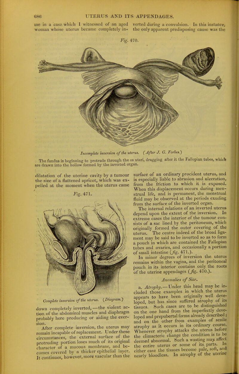 me ill a case which 1 witnessed of an aged verted during a convulsion. In this instance, woman whose uterus became completely in- the only apparent predisposing cause was the Fig. 470. Tticompkte inversion of the uterus. (After J. G. Forbes.') The fundus is beginning to protrude through the os uteri, dragging after it the Fallopian tubes, which are drawn into the hollow formed by the inverted organ. dilatation of the uterine cavity by a tumour the size of a flattened apricot, which was ex- pelled at the moment when the uterus came Fig. 471. Complete inversion of the uterus. (Diagram.) down completely inverted, —the violent ac- tion of the abdominal muscles and diaphragm probably here producing or aiding the ever- sion. After complete inversion, the uterus may remain incapable of replacement. Under these circumstances, the external surface of the protruding portion loses much of its original character of a mucous membrane, and be- comes covered by a thicker epithelial layer. It continues, however, more vascular than the surface of an ordinary procident uterus, and is especially liable to abrasion and ulceration, from the friction to which it is exposed. When this displacement occurs during men- strual life, and is permanent, the menstrual fluid may be observed at the periods exuding from the surface of the inverted organ. The internal relations of an inverted uterus depend upon the extent of the inversion. In extreme cases the interior of the tumour con- sists of a sac lined by the peritoneum, which originally formed the outer covering of the ute'rus. The centre indeed of the broad liga- ment may be said to be inverted so as to form a pouch in which are contained the Fallopian tubes and ovaries, and occasionally a portion ofsmall intestine (/g. 471.). _ In minor degrees of inversion the uterus remains within the vagina, and tiie peritoneal pouch in its interior contains only the roots of the uterine appendages (Jig. 470.). Anomalies of Size. a. Atrophy.—Under this head may be in- cluded those examples in which the uterus appears to have been originally well deve- loped, but has since suffered atrophy of its tissues. Such cases are to be distinguished on the one hand from the imperfectly deve- loped and prepubertal forms already described ; and on the other from examples of senile atrophy as it occurs in its ordinary course. Whenever atrophy attacks the uterus before the climacteric change the condition is to be deemed abnormal. Such a wasting may attect the entire uterus or some of its. parts. In either case the tissues become pale, soft, and nearly bloodless. In atrophy of the uterine